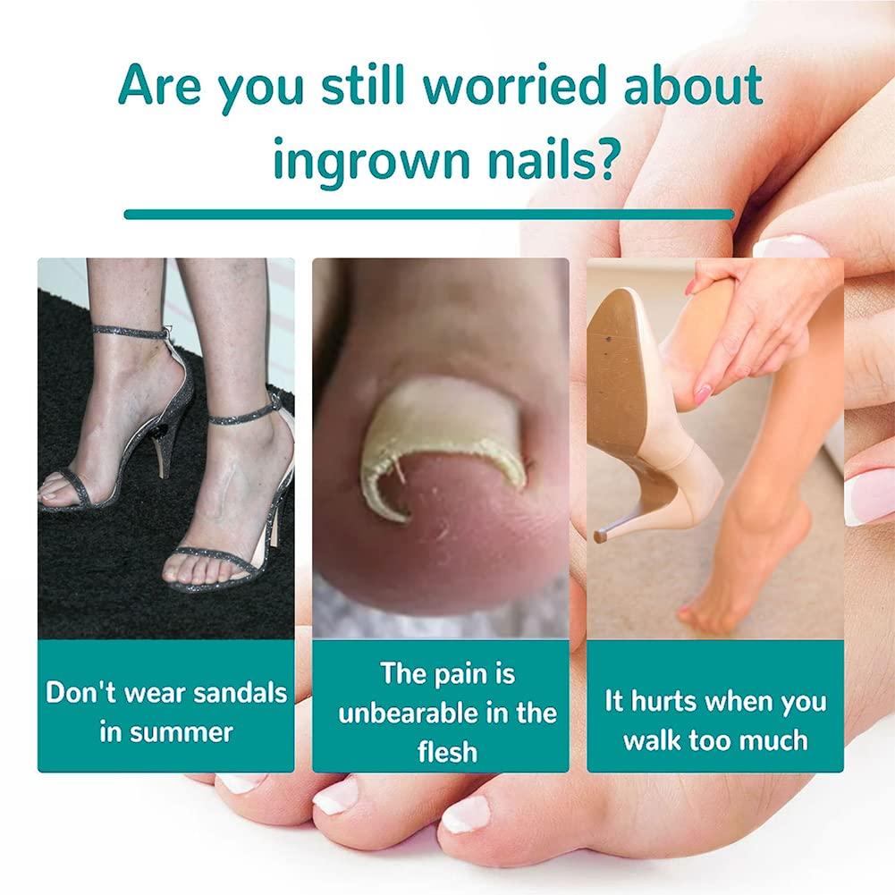 Ingrown Toenail Correction Stickers Professional Elastic Patch for