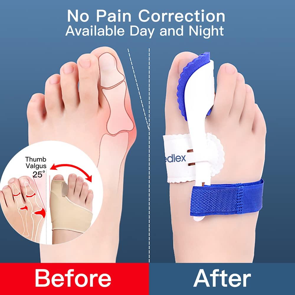 Bunion Corrector, Feedlex Hallux Valgus Brace Splint Pads Bunion Big