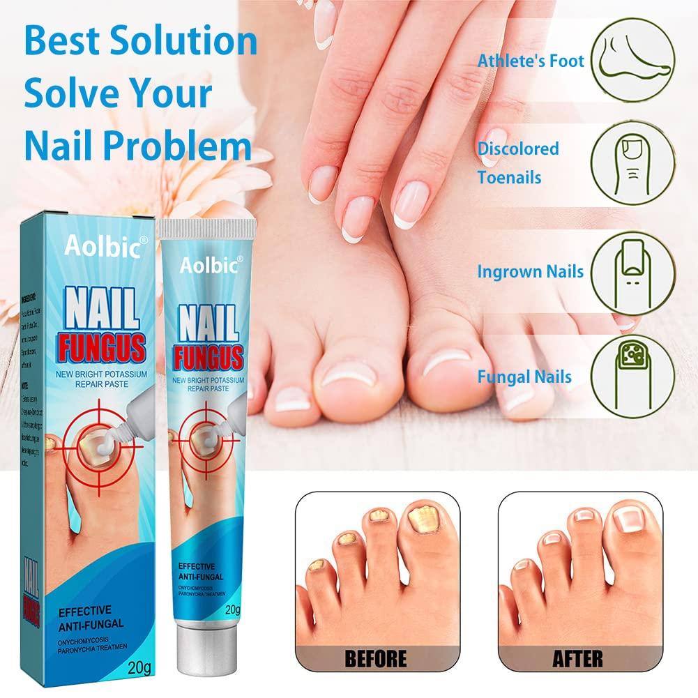 Is Clotrimazole The Best Treatment for Nail Fungus??? - YouTube
