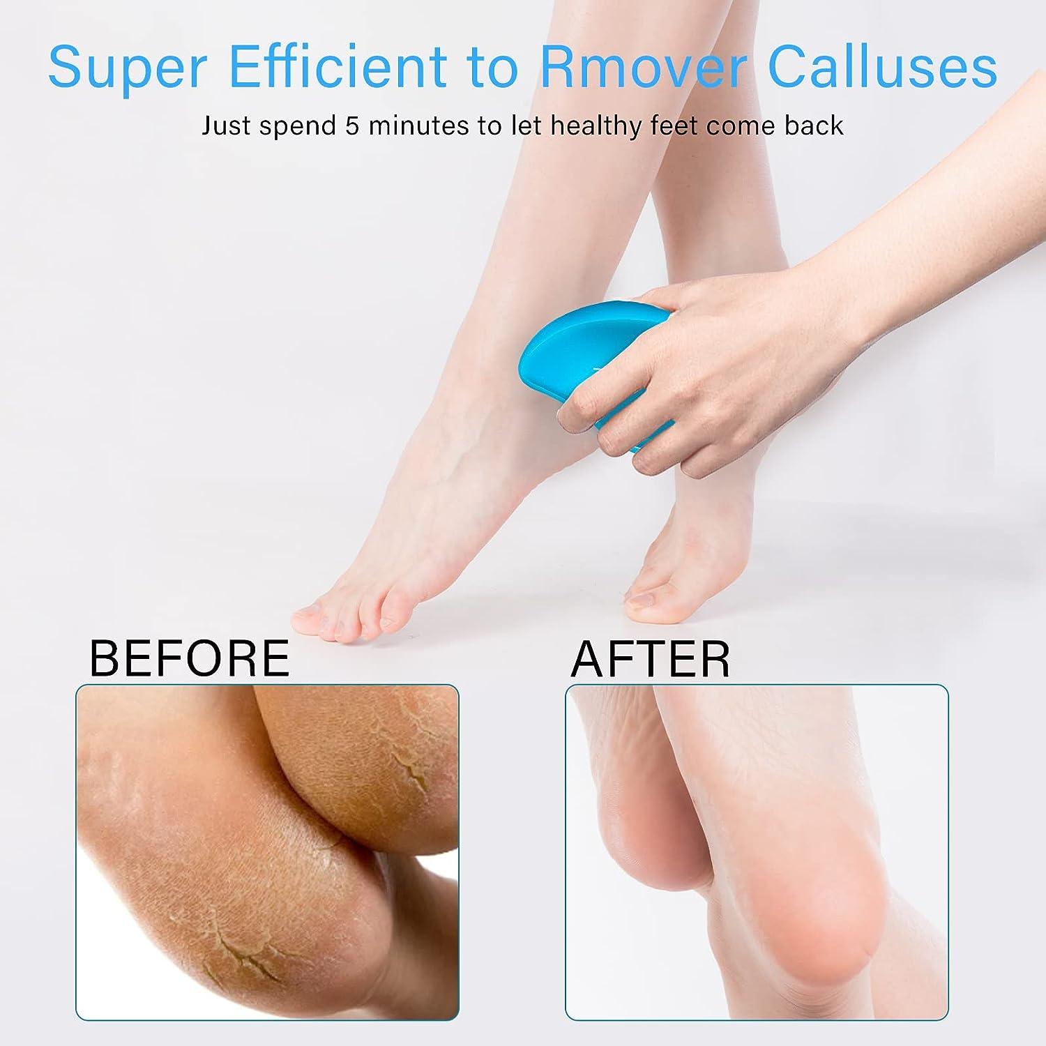 Dead Skin Remover for Feet, Foot Scrubber for Use in Shower, Foot File  Callus Remover for Feet, Foot Scraper & Glass Foot File Callus Remover Tool