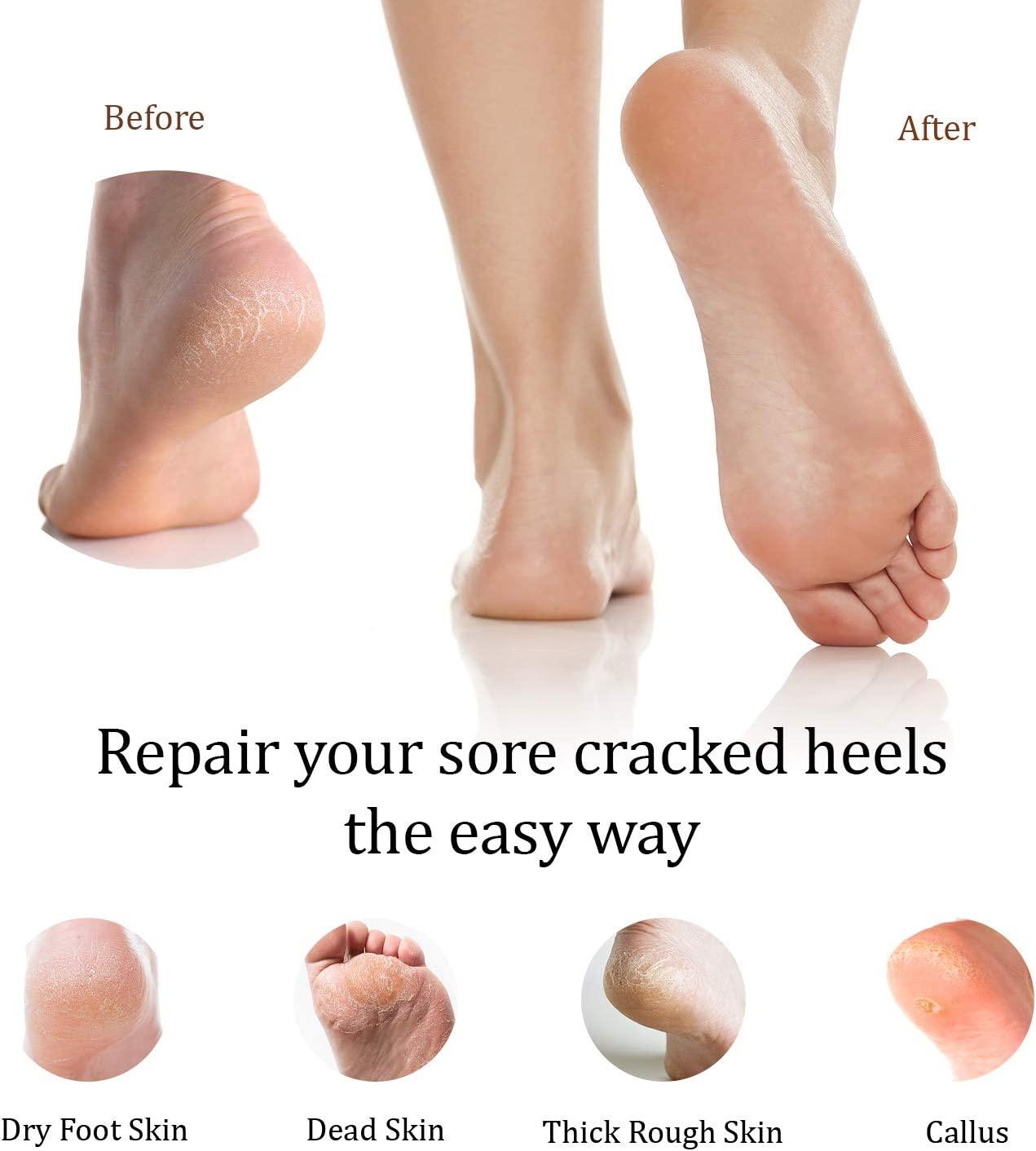 Easy Home Remedy for Dry Cracked Heels - Savory Lotus
