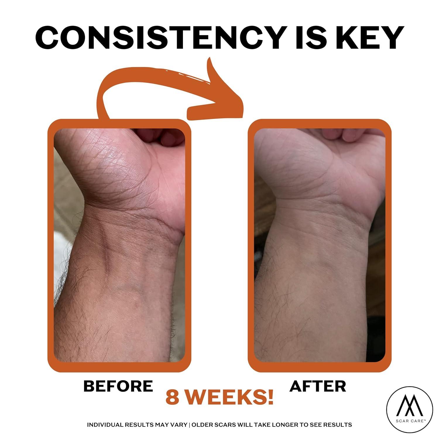 Motivo Advanced Scar Care Bundle Scar Tape & Scar Cream (15ml) Water