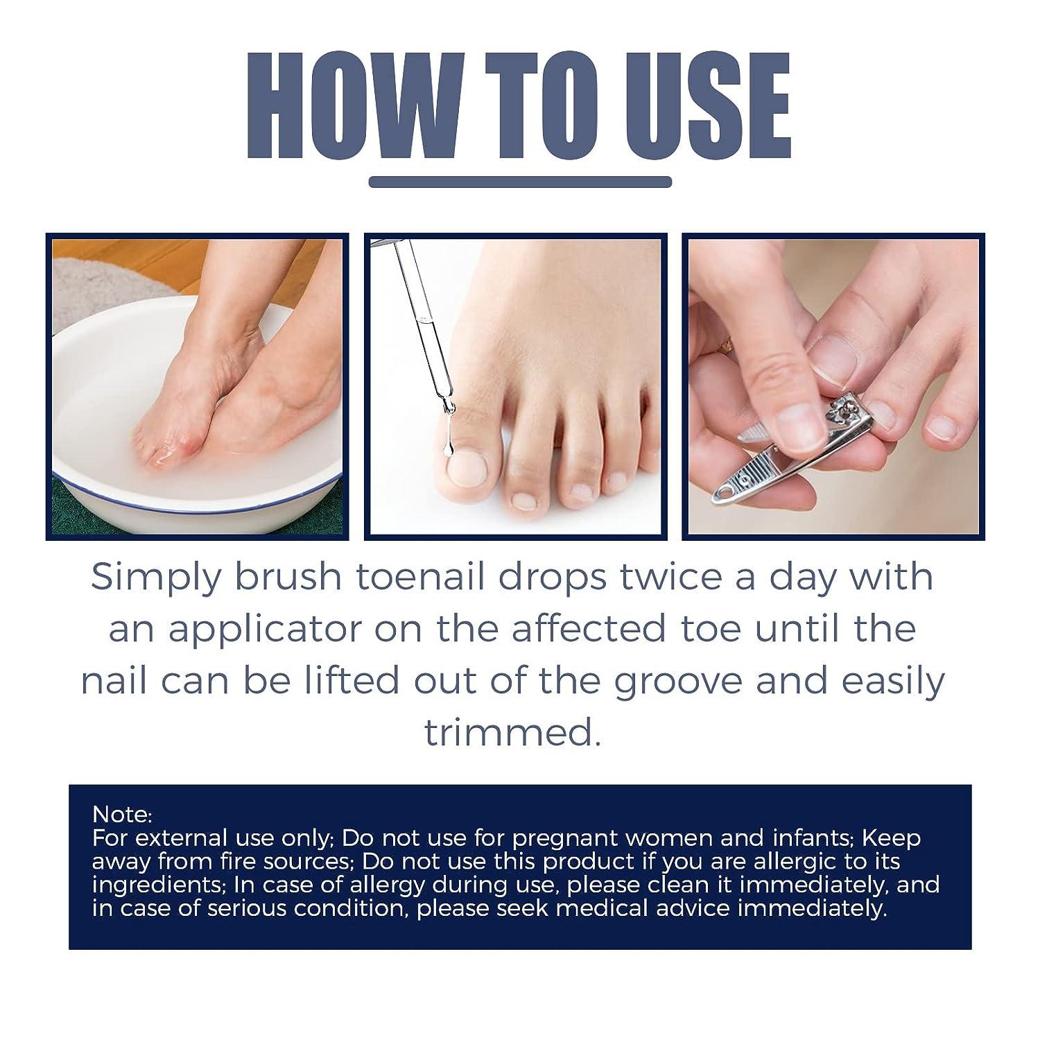 Ingrown Fingernail - 5 Ways You Can Treat It! - By Dr. Sruthi Gondi |  Lybrate