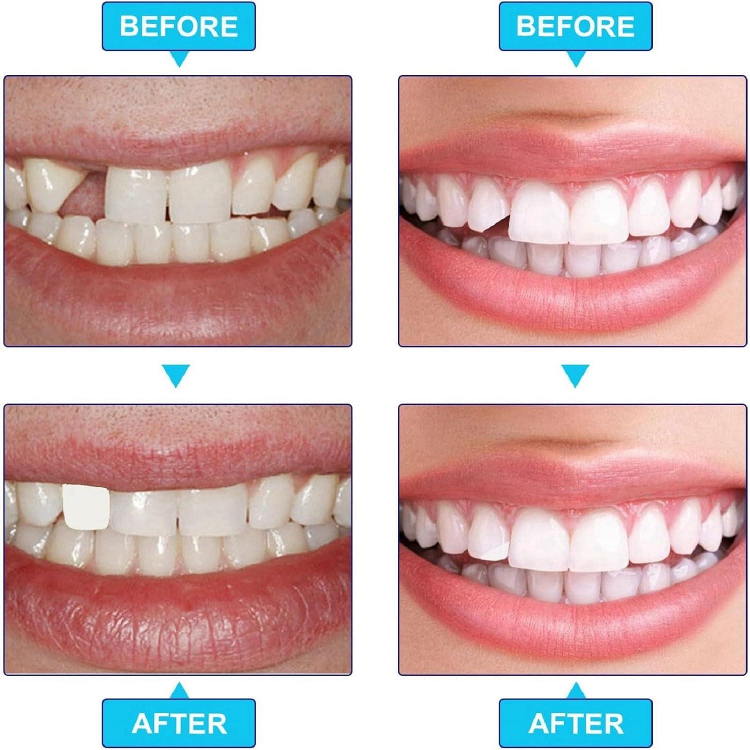 70PCS Temporary Tooth Crown Repair Kit - Dental Replacement Caps for ...