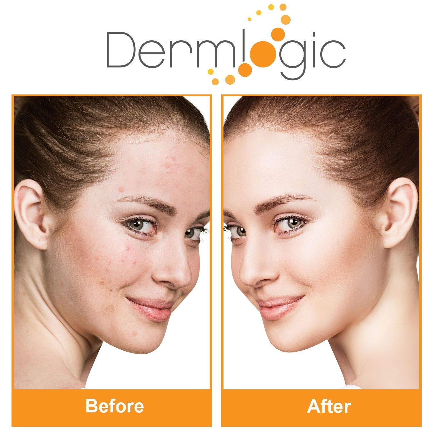 Acne Treatment Control Pads Contains Salicylic Glycolic & Lactic Acid