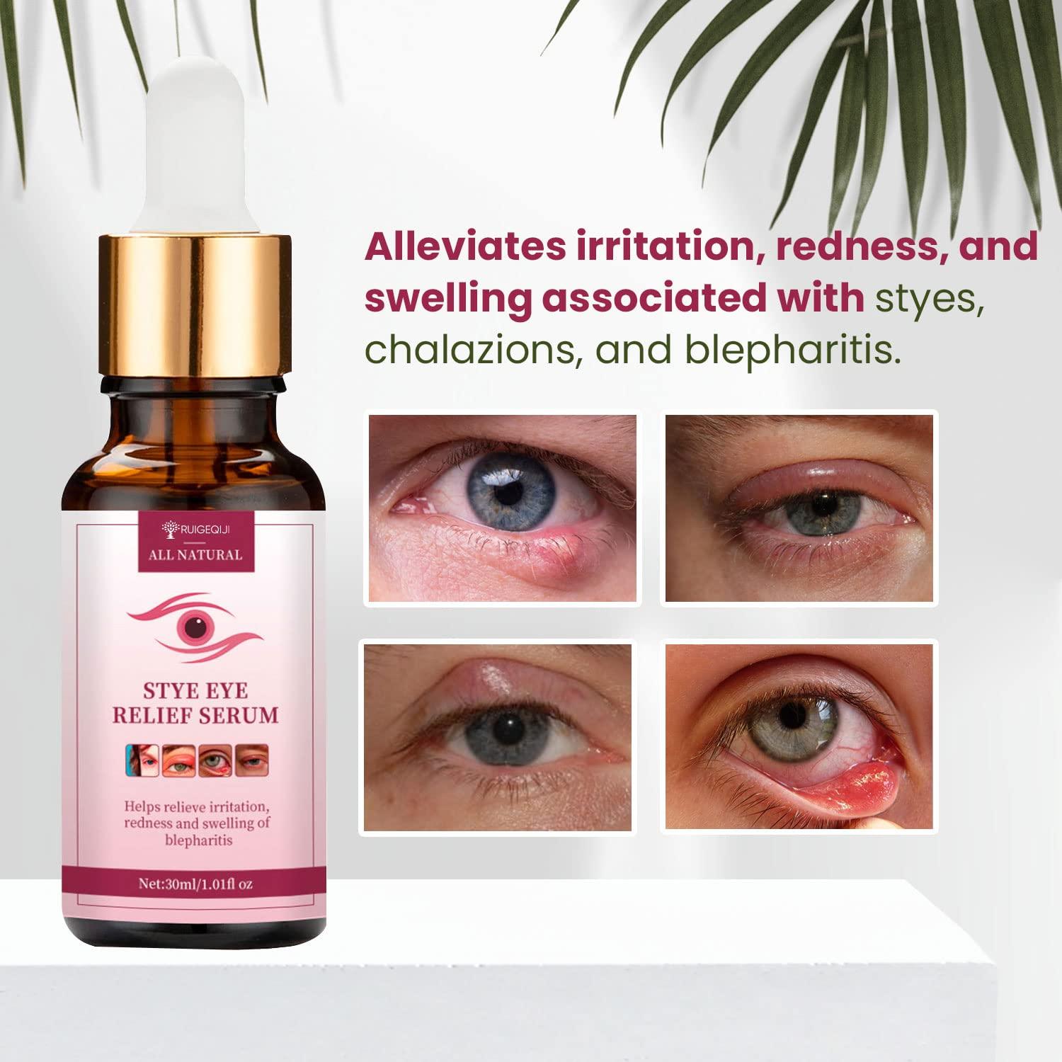 Stye Eye Treatment & Chalazion Remover Fast Relief Serum by RUIGEQIJI