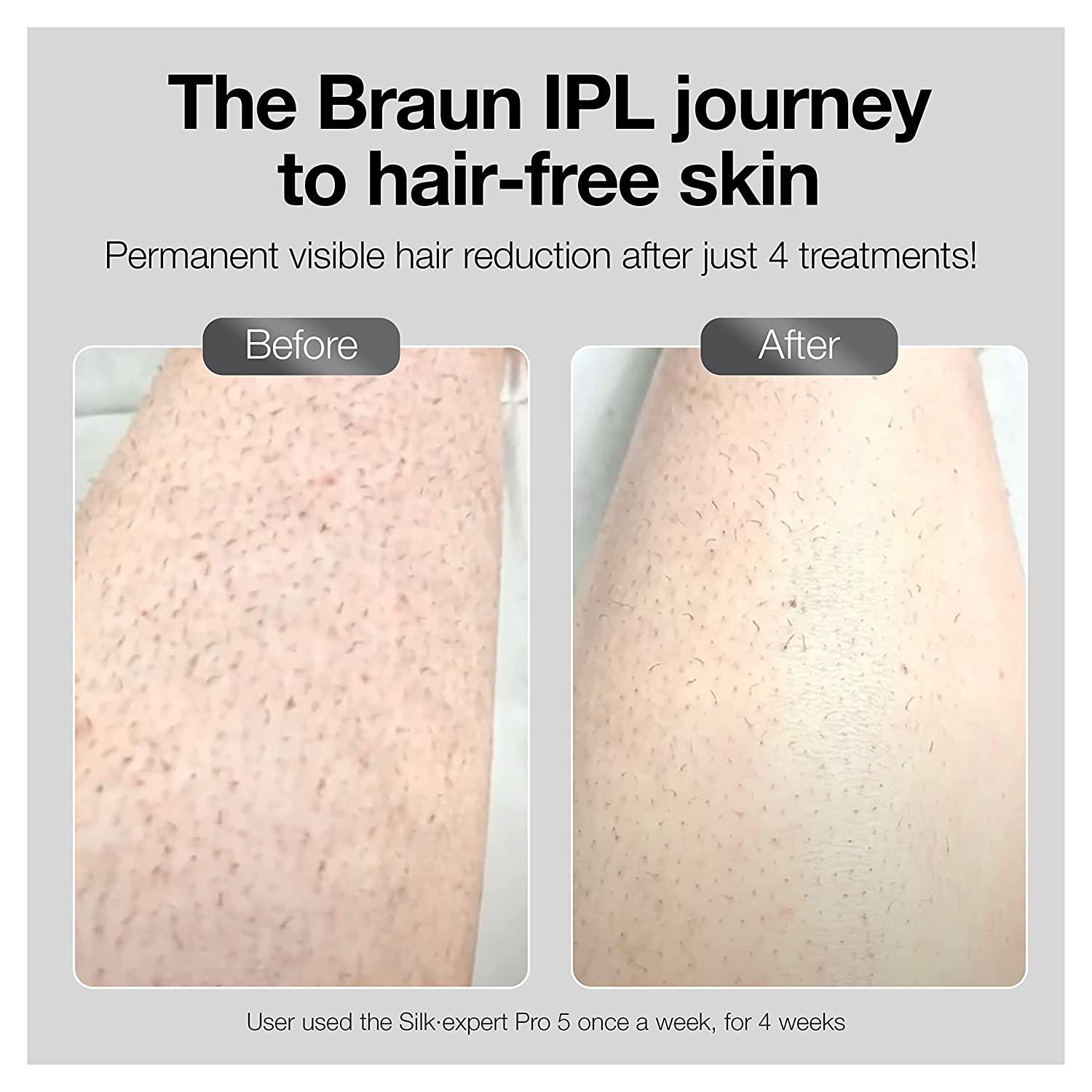 Braun IPL Permanent Hair Removal System for Women and Men, NEW Silk Expert  Pro 3 PL3221, Head-to-toe Usage, FDA Cleared, for Body & Face, Alternative  to Salon Laser Hair Removal, With 3