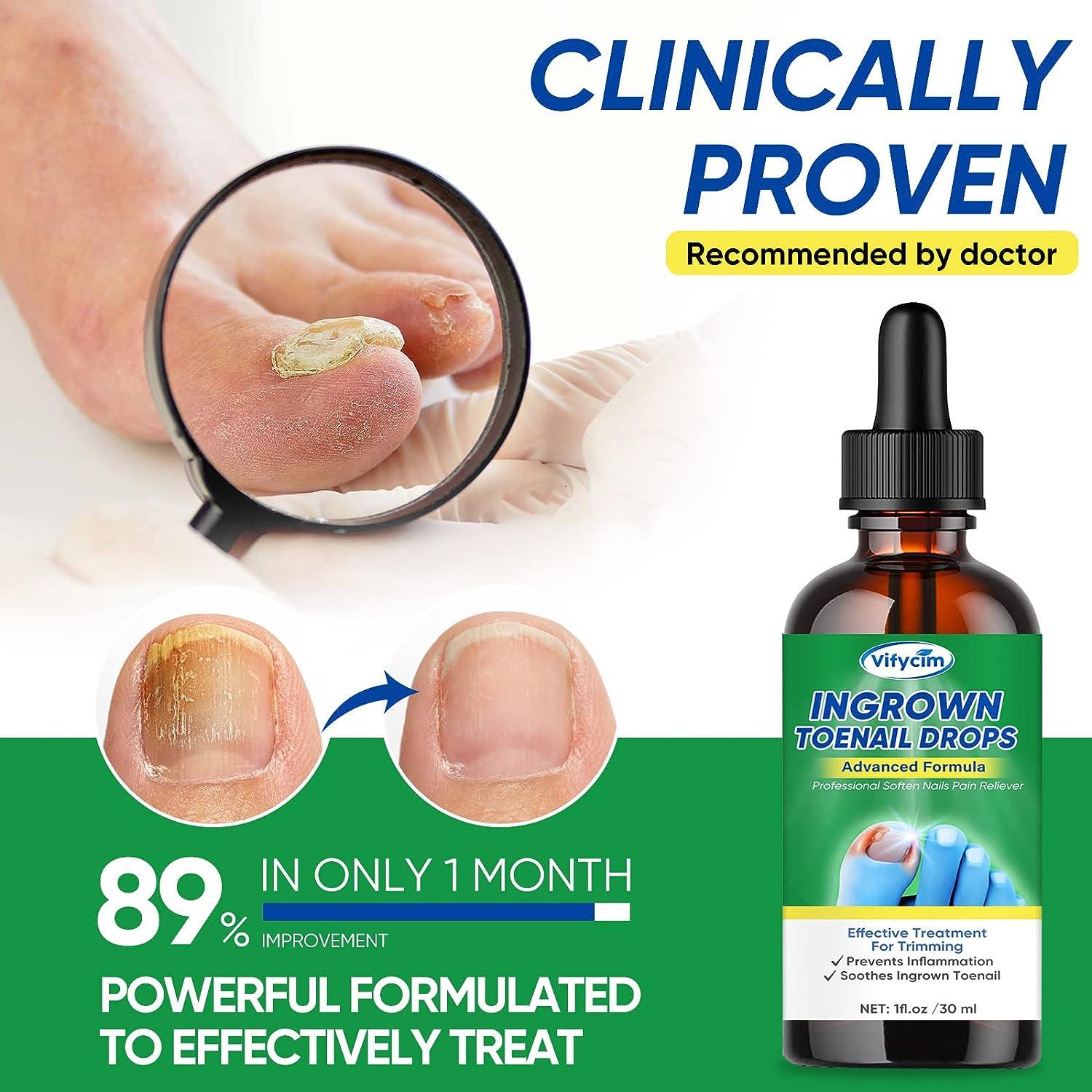 Ingrown Toenail Treatment Ingrown Toenail Corrector Drops Professional