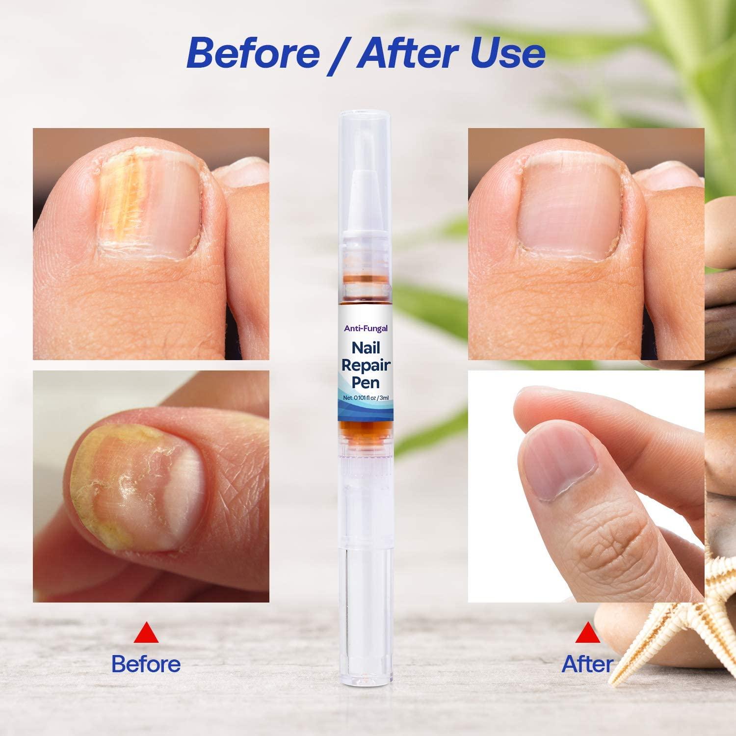Toenail Fungus Treatment Antibacterial Nail Repair Care Pen Anti-fungal  Treatment - Walmart.com