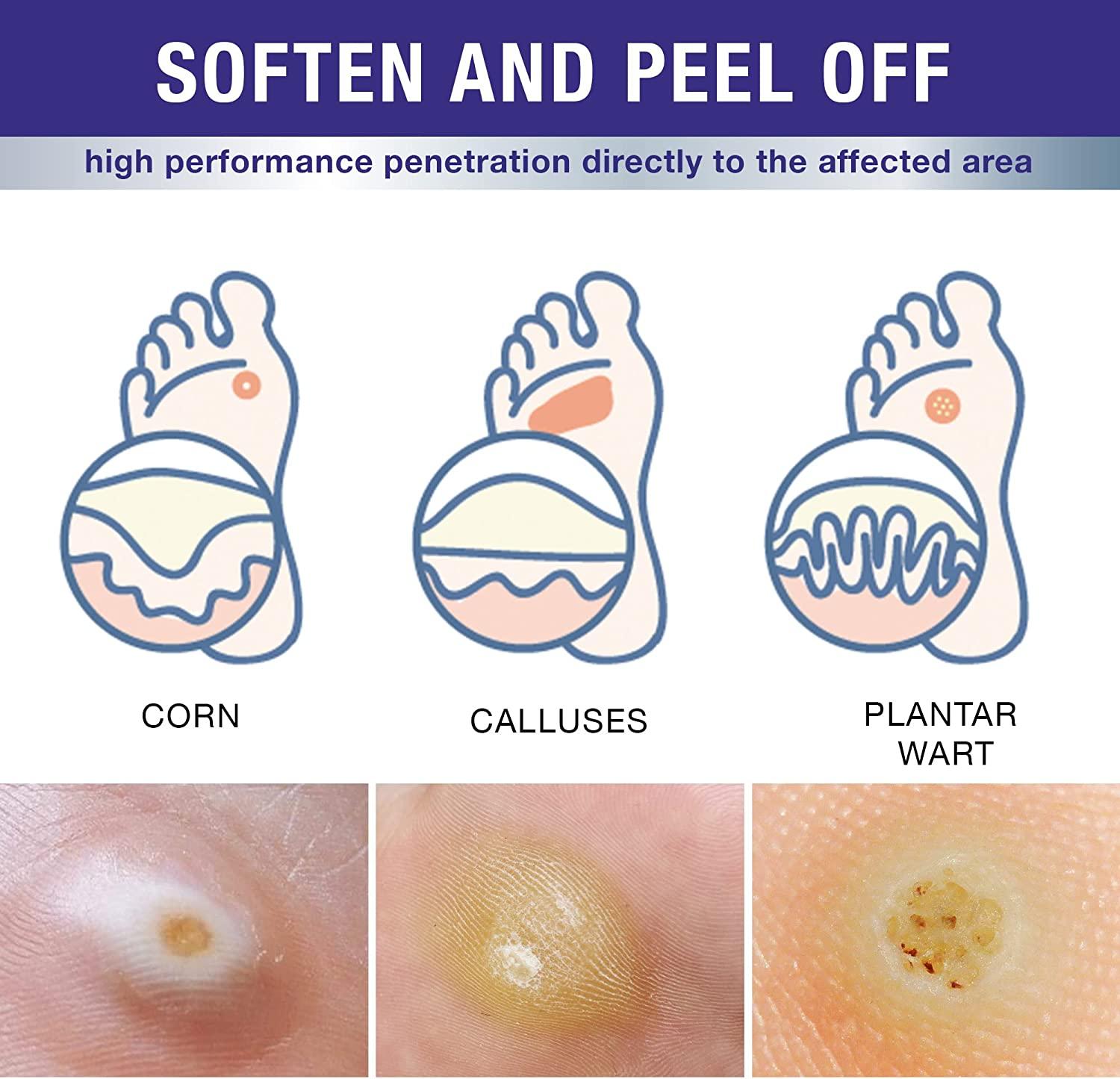 Liquid Corn Remover Mask, Exclusive Formula Liquid Wart Remover Patch