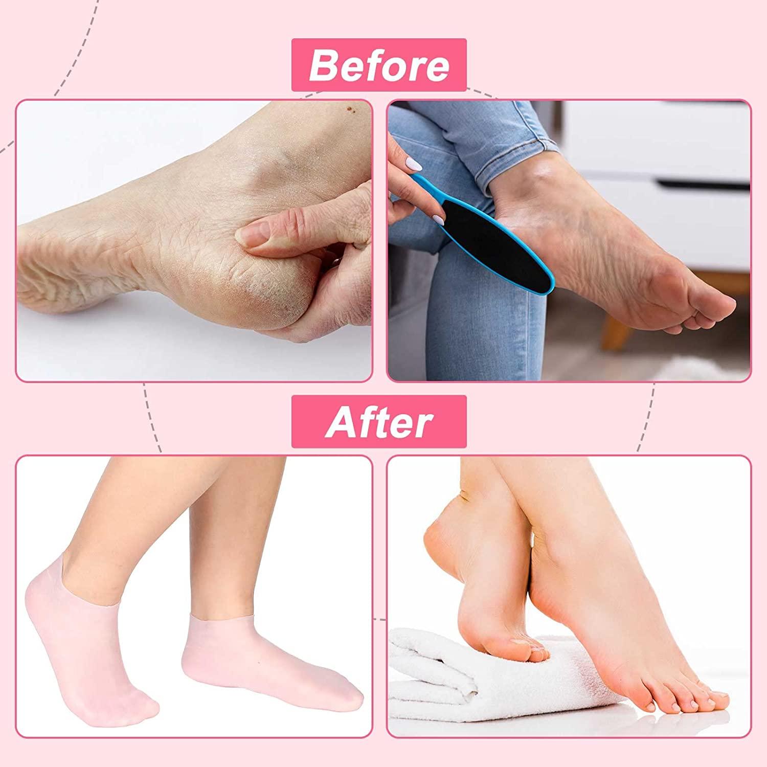 SATINIOR Silicone Socks 3 Pairs Aloe Socks Silicone Gel Heel Socks Anti  Slip Silicone Moisturizing Socks for Women Men Dry Cracking Skin (Medium),  Pink, Beige and White,Medium 