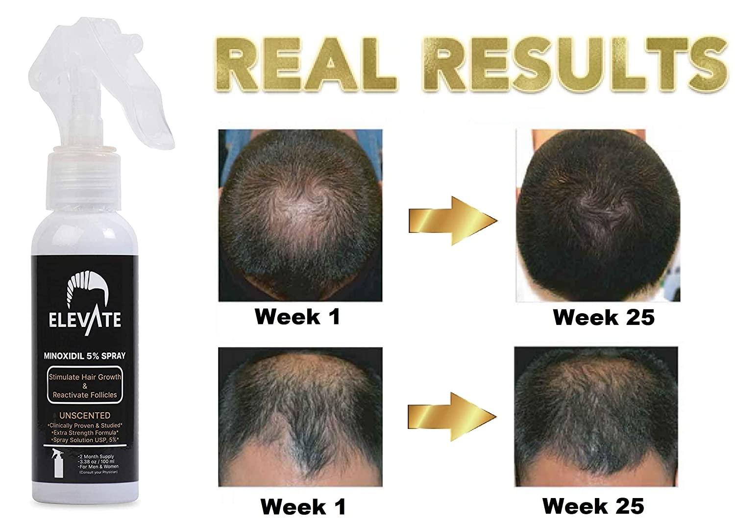 ELEVATE 5% Minoxidil Hair Growth Spray - Extra Strength Professional  Treatment for Hair Loss and Hair Regrowth - Stimulate Hair Follicles for  Men & Women - 1 to 2 Month Supply 100ml  Fl Oz (Pack of 1)