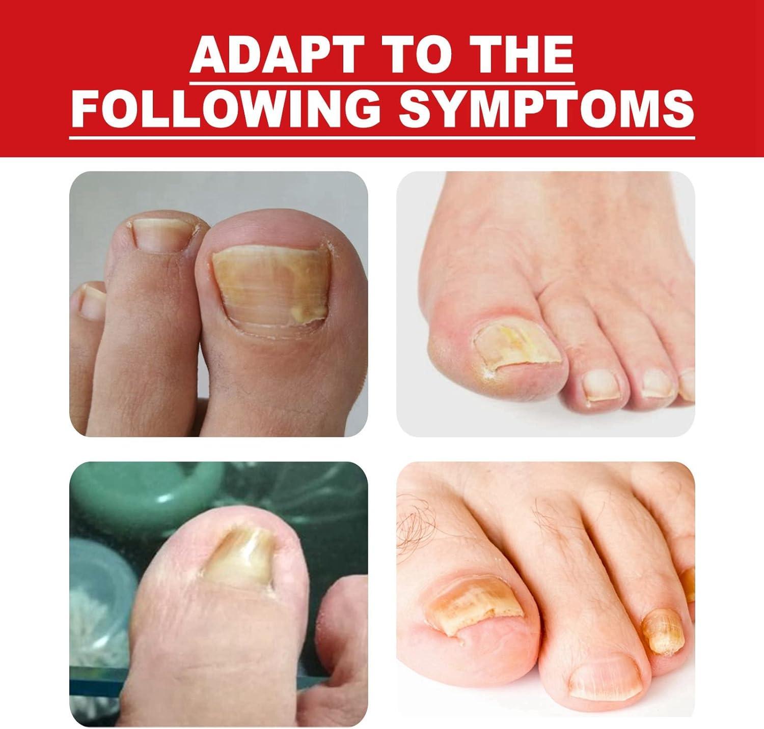 Darkened bruised big toe (hallux) toenail on the foot of a Caucasian male  discoloured by bruising trauma of the nail bed (poorly fitting walking boot  Stock Photo - Alamy