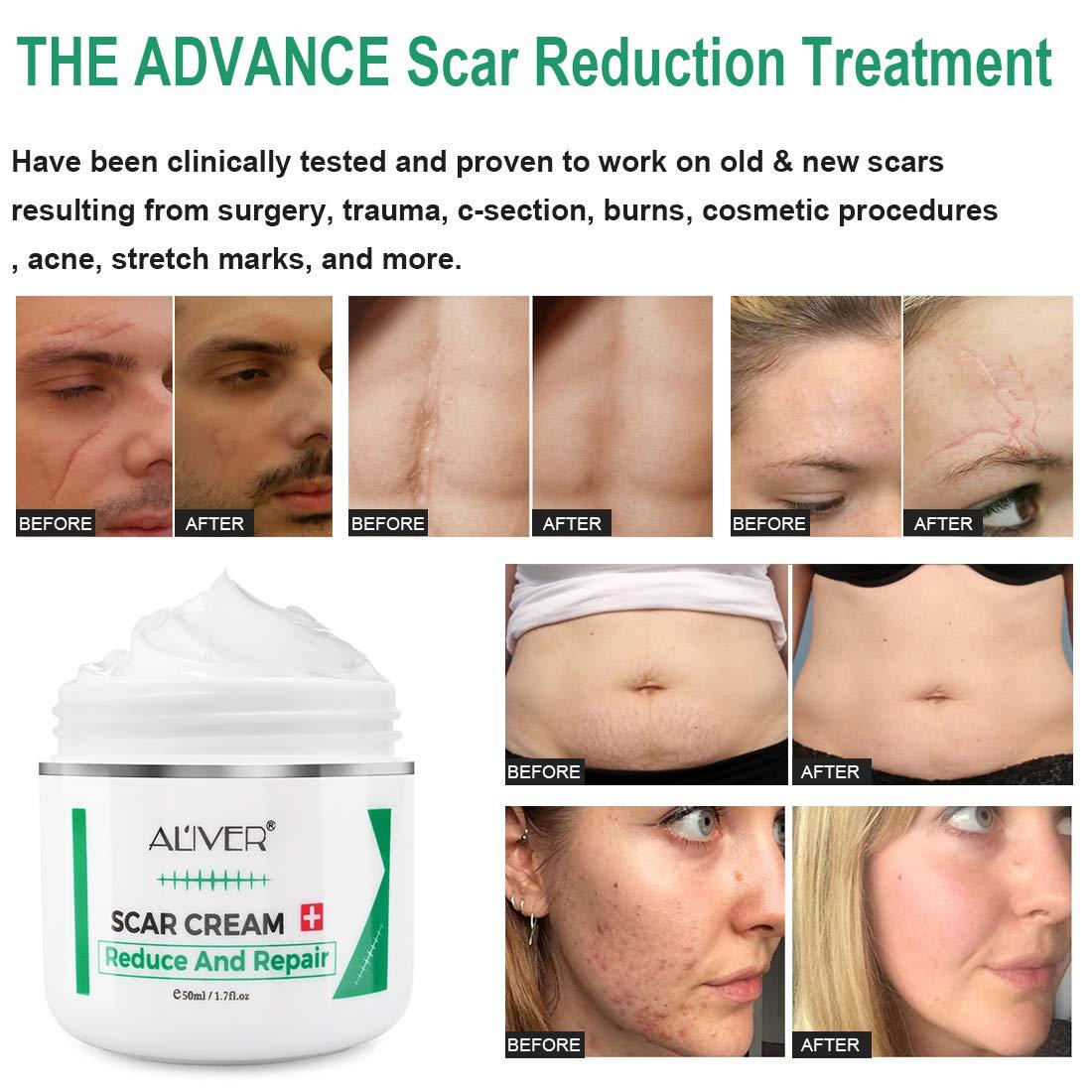 Scar Cream For Old Scars Stretch marks Scar Gel Treatment surgical