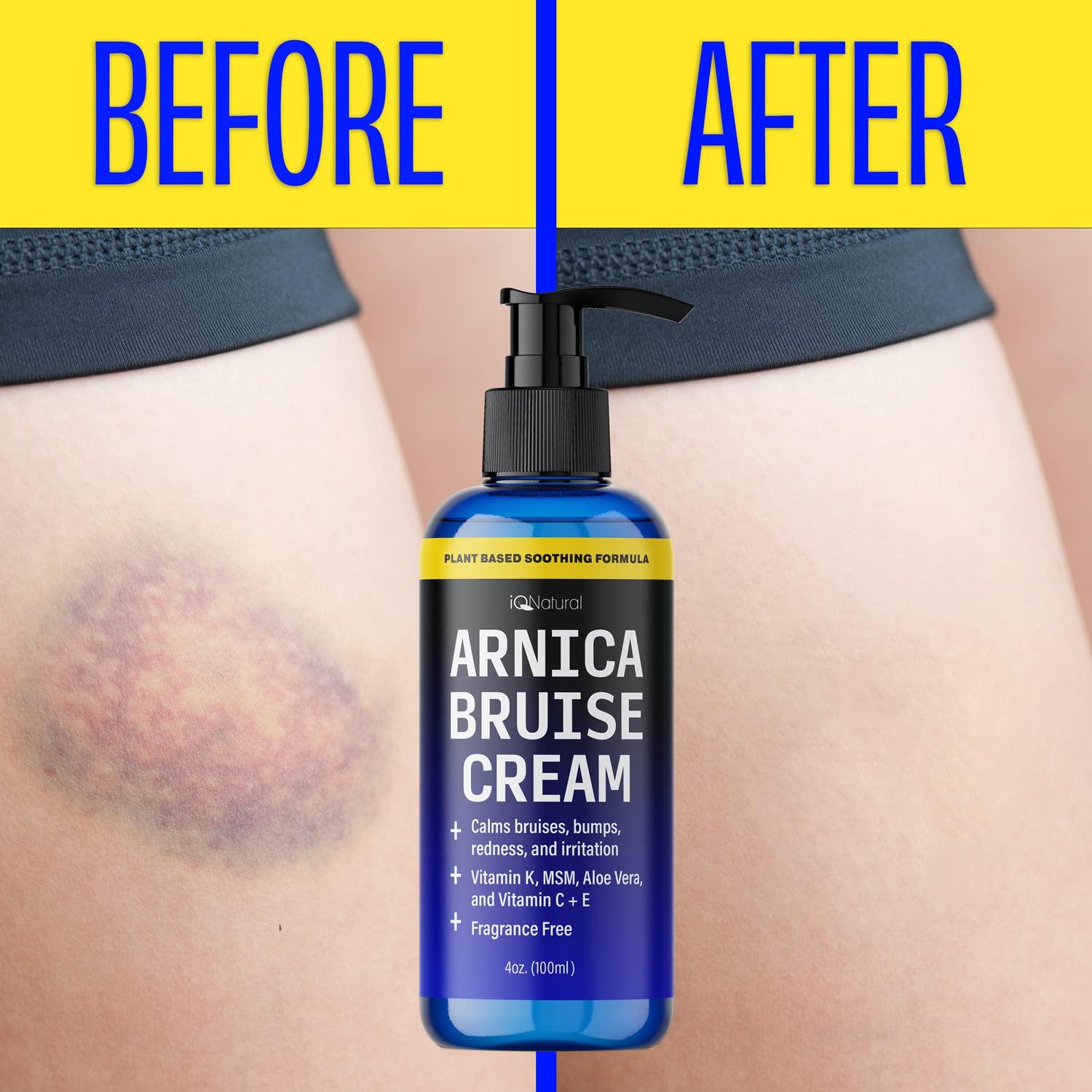 iQ Natural Arnica Cream for Bruising and Swelling Arnica Montana Bruise