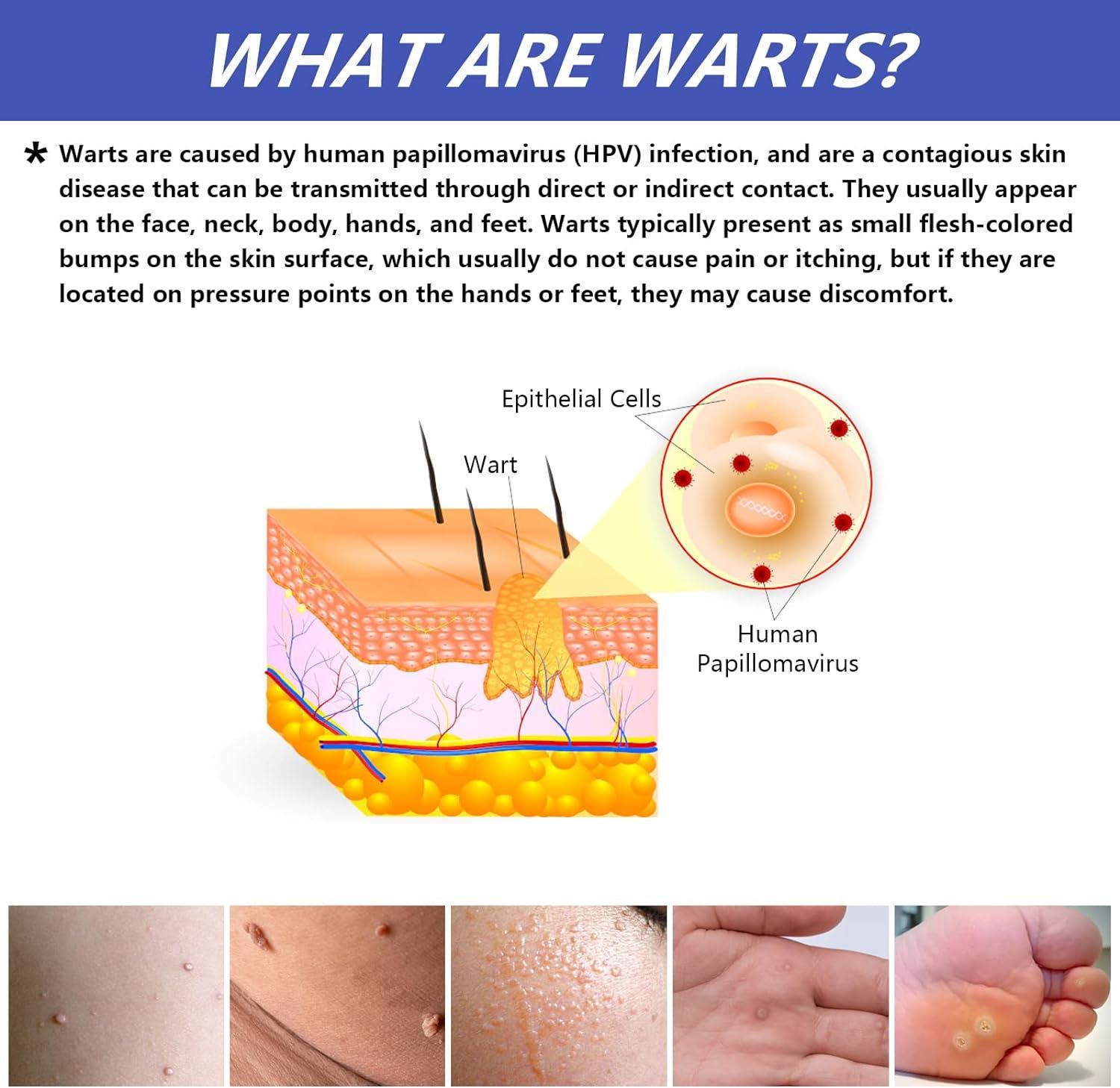 Fast-Acting Liquid Wart Remover for Plantar Wart Treatment - Removes ...