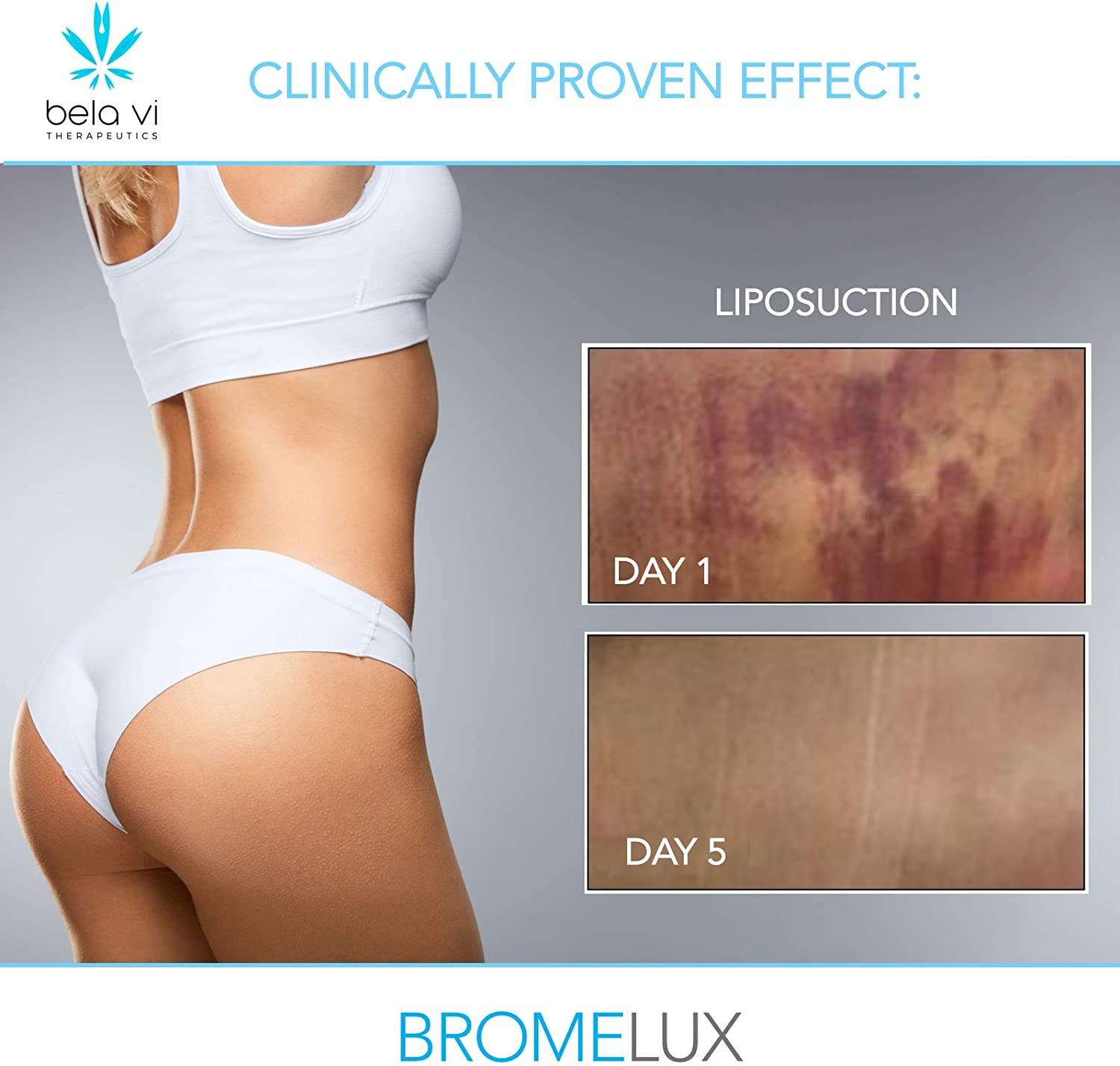 BROMELUX AntiBruising Supplement Bromelain & Quercetin Complex for Swelling & Bruise Relief