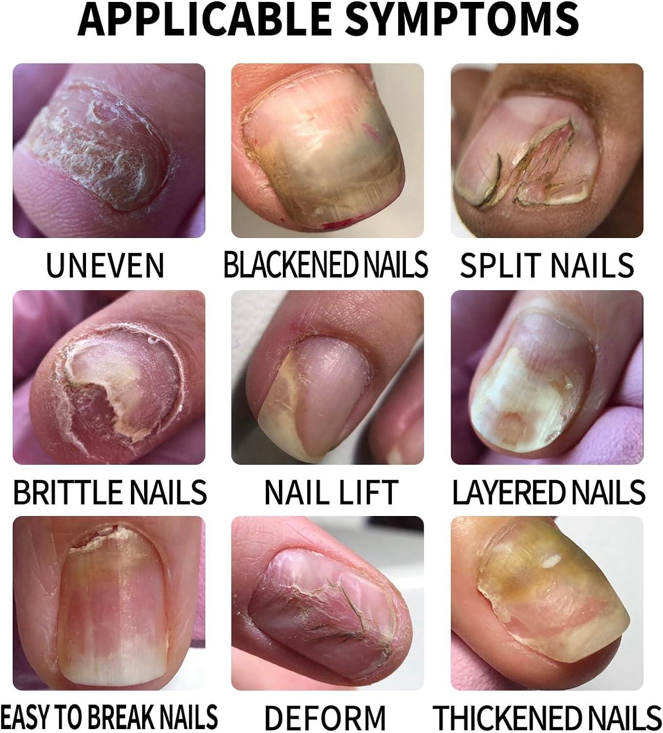 Brittle Nails Treatment - Afecto Homeopathy®