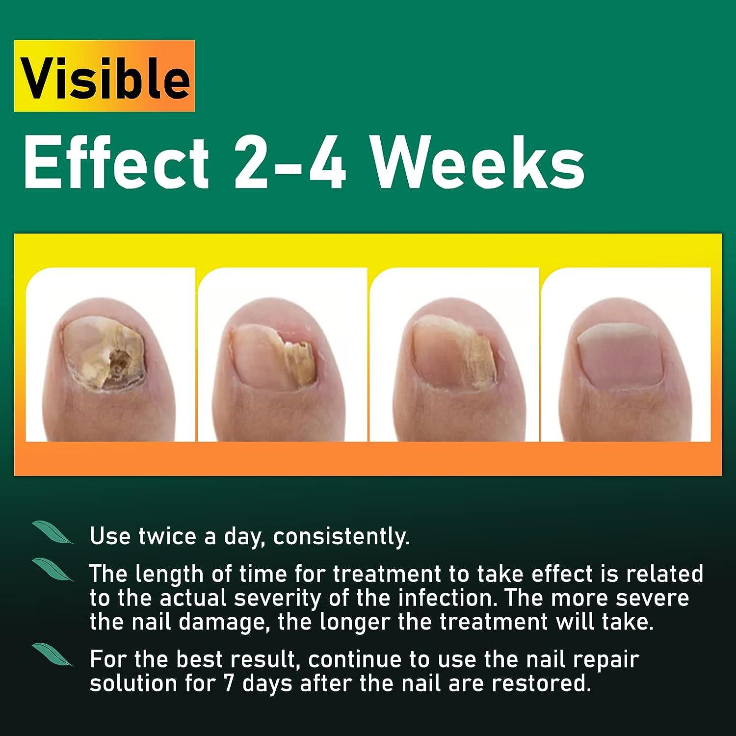 XIFEPFR Toenail Repair Treatment Extra Strength, Nail Repair Solution