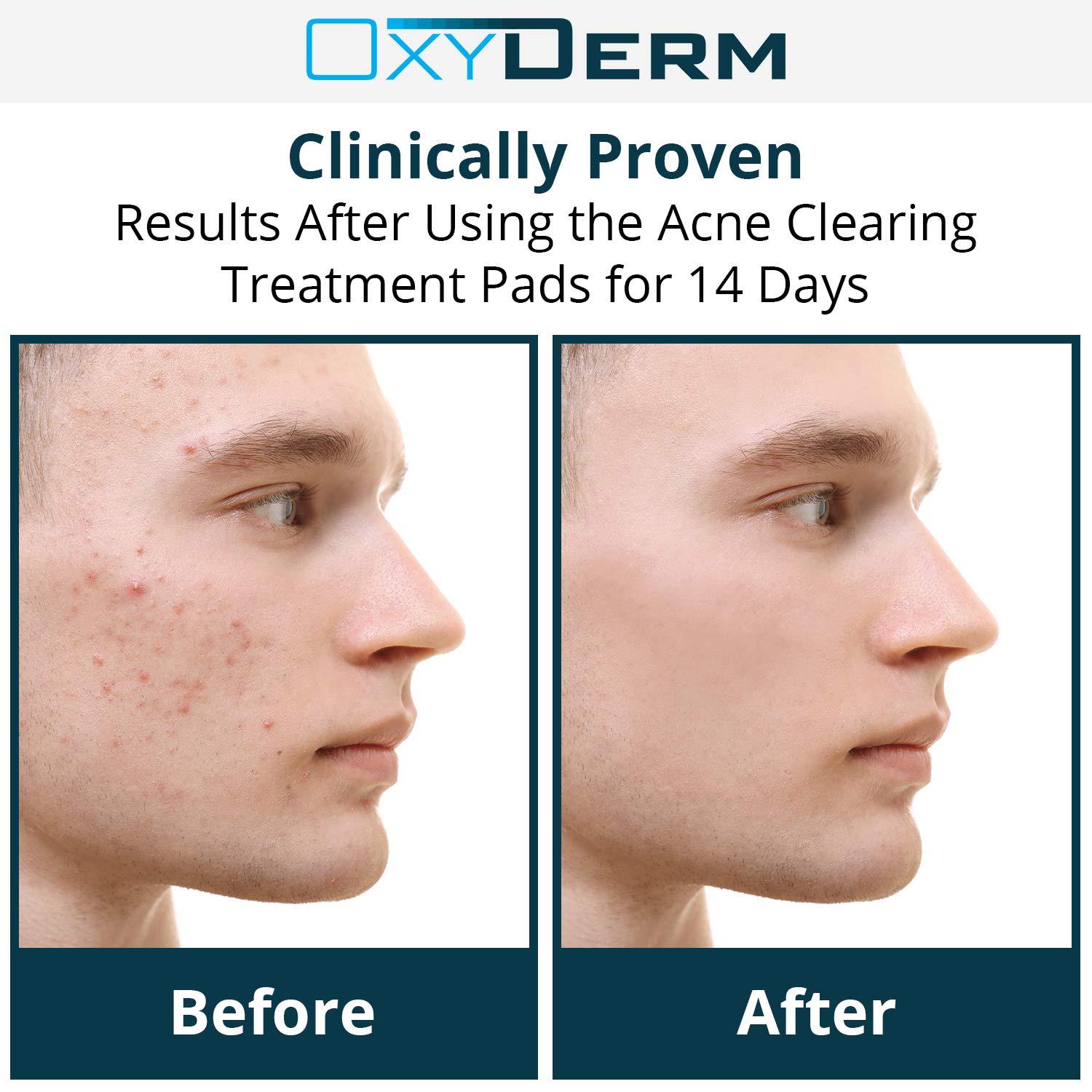 Acne Clearing Treatment Pads Exfoliating Peel Pads, Eliminates Acne