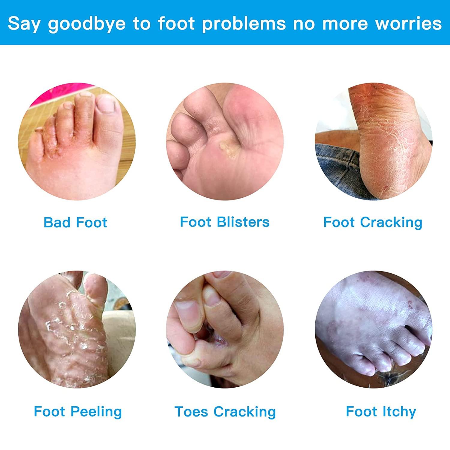 How To Prevent & Treat Athlete's Foot