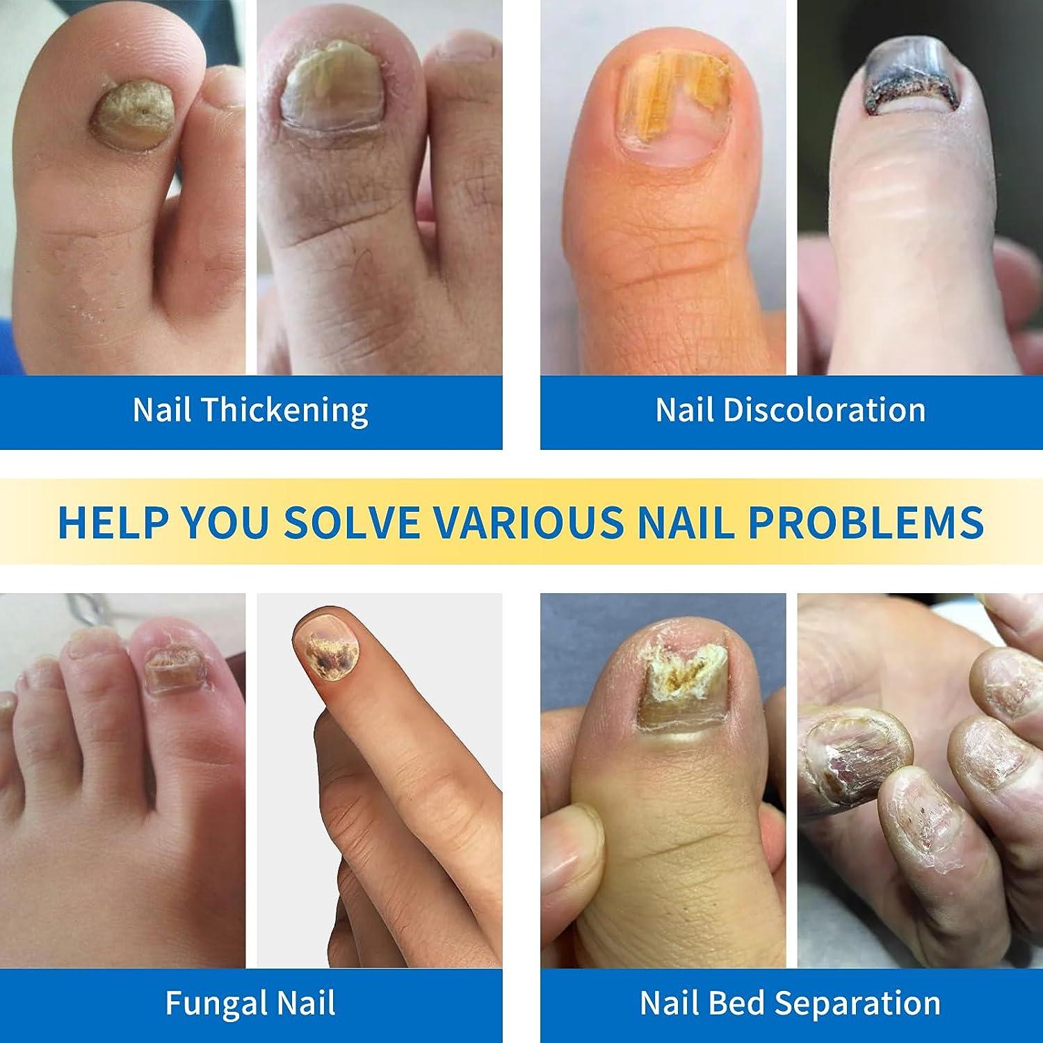 Nail Fungus Laser Treatment Device Home Use Fungus Nail Treatment for