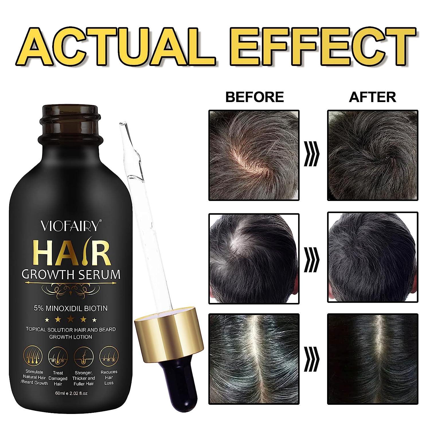 5% Minoxidil Hair Growth Oil for Men & Women - Biotin Serum