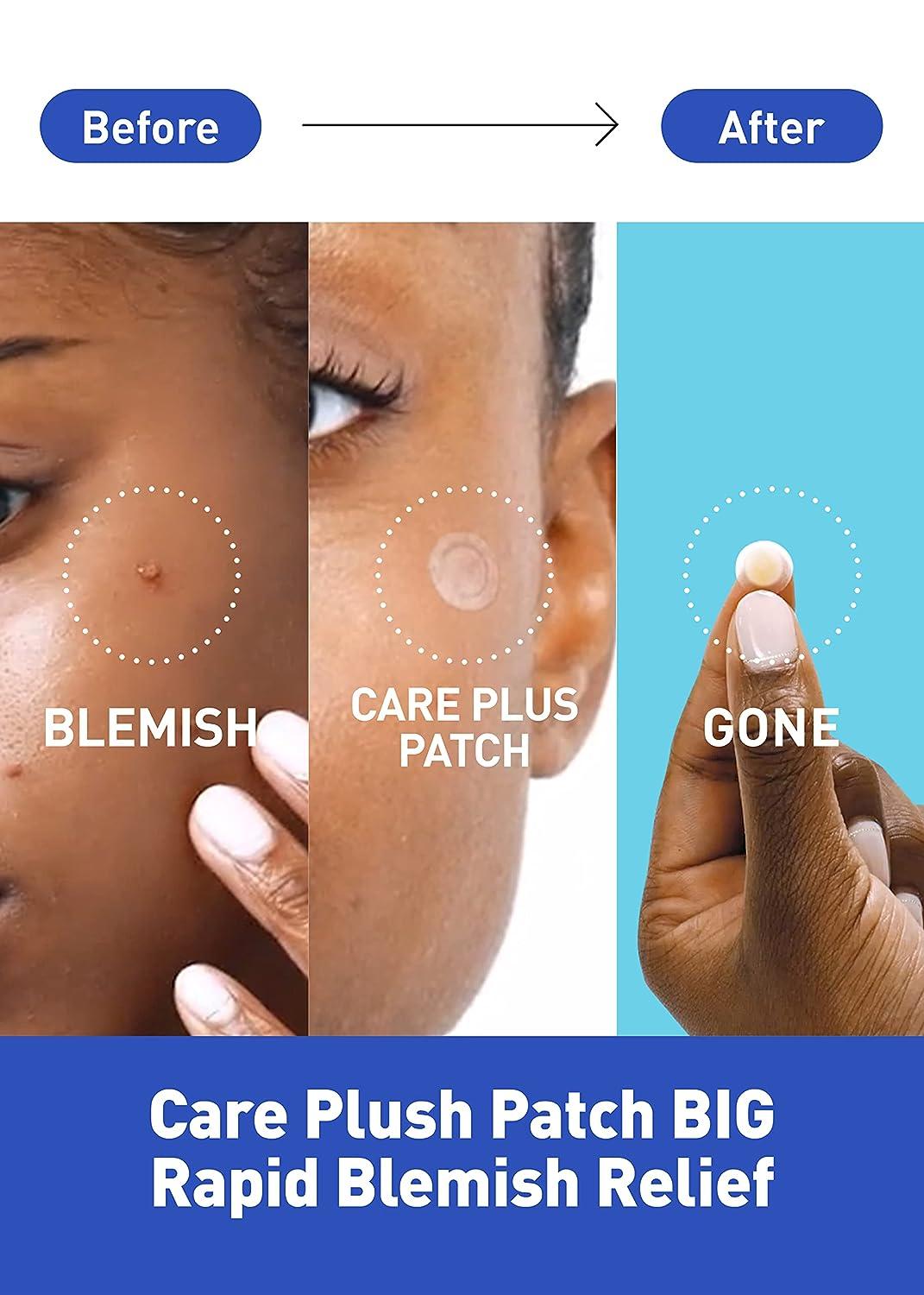 Olive Young Care Plus Spot Patch Big (81 Count) | Hydrocolloid Acne Pimple  Stickers - 81 Count | Buy Now with Express International Delivery