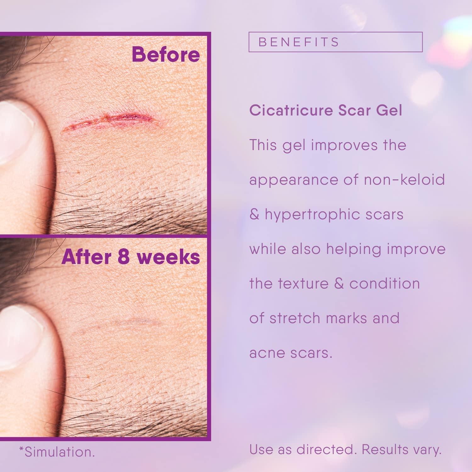 Cicatricure Face & Body Scar Gel 1oz Reduces Old & New Scars, Stretch Marks, Surgery, Injuries