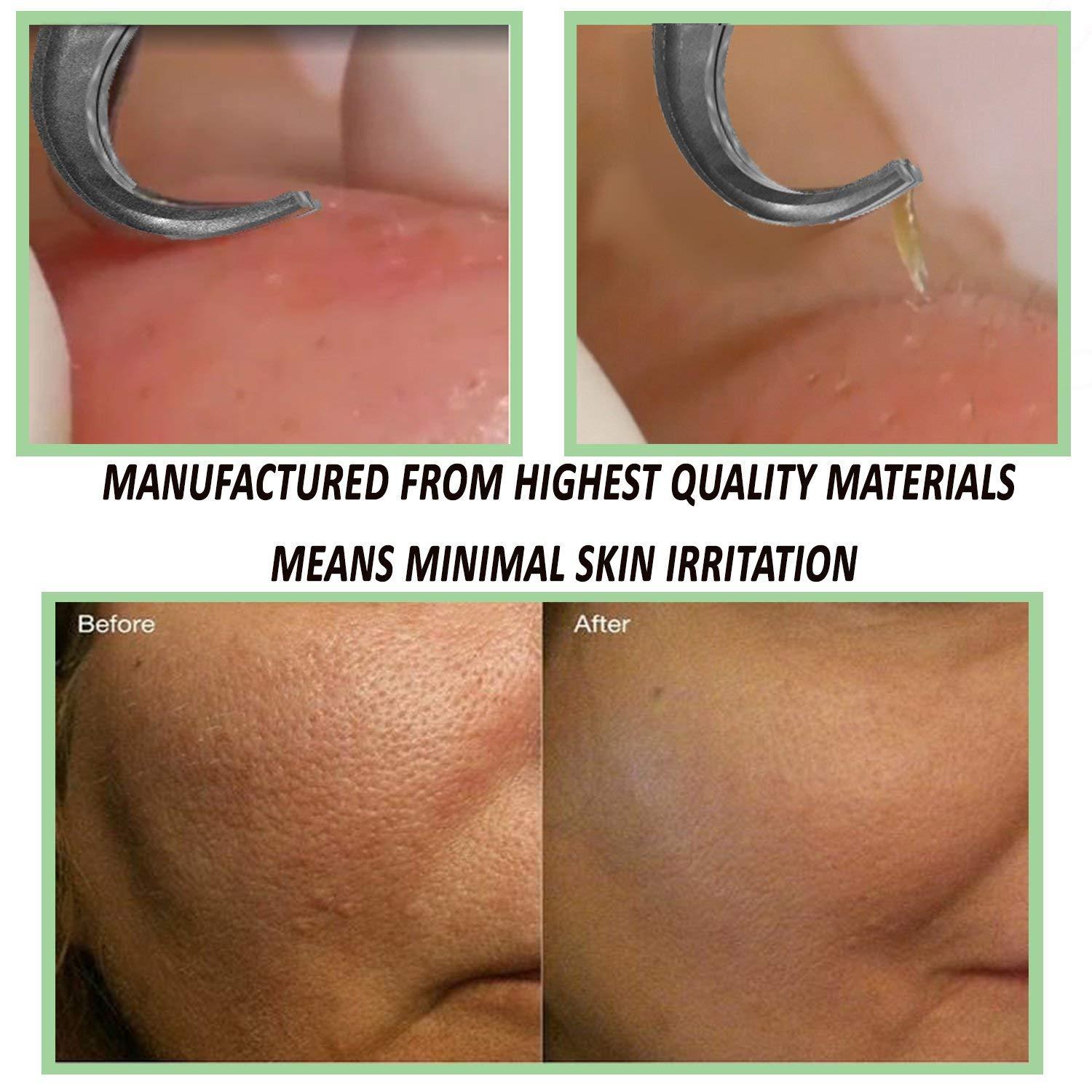 Blackhead Acne Extraction Tweezers FEITA Pro & SurgicalGrade