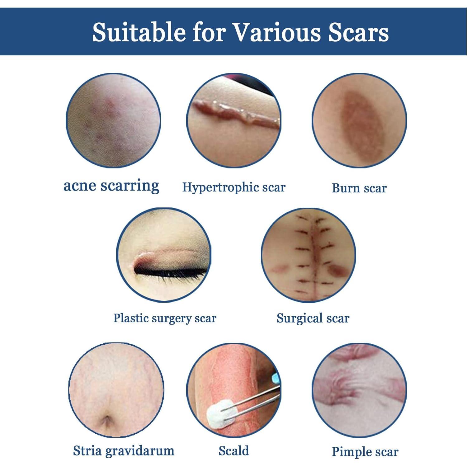 Scar Gel Scar Eraser Scar Removal Gel Skin Repair Gel Scar to Soothe the Skin Scars Effective