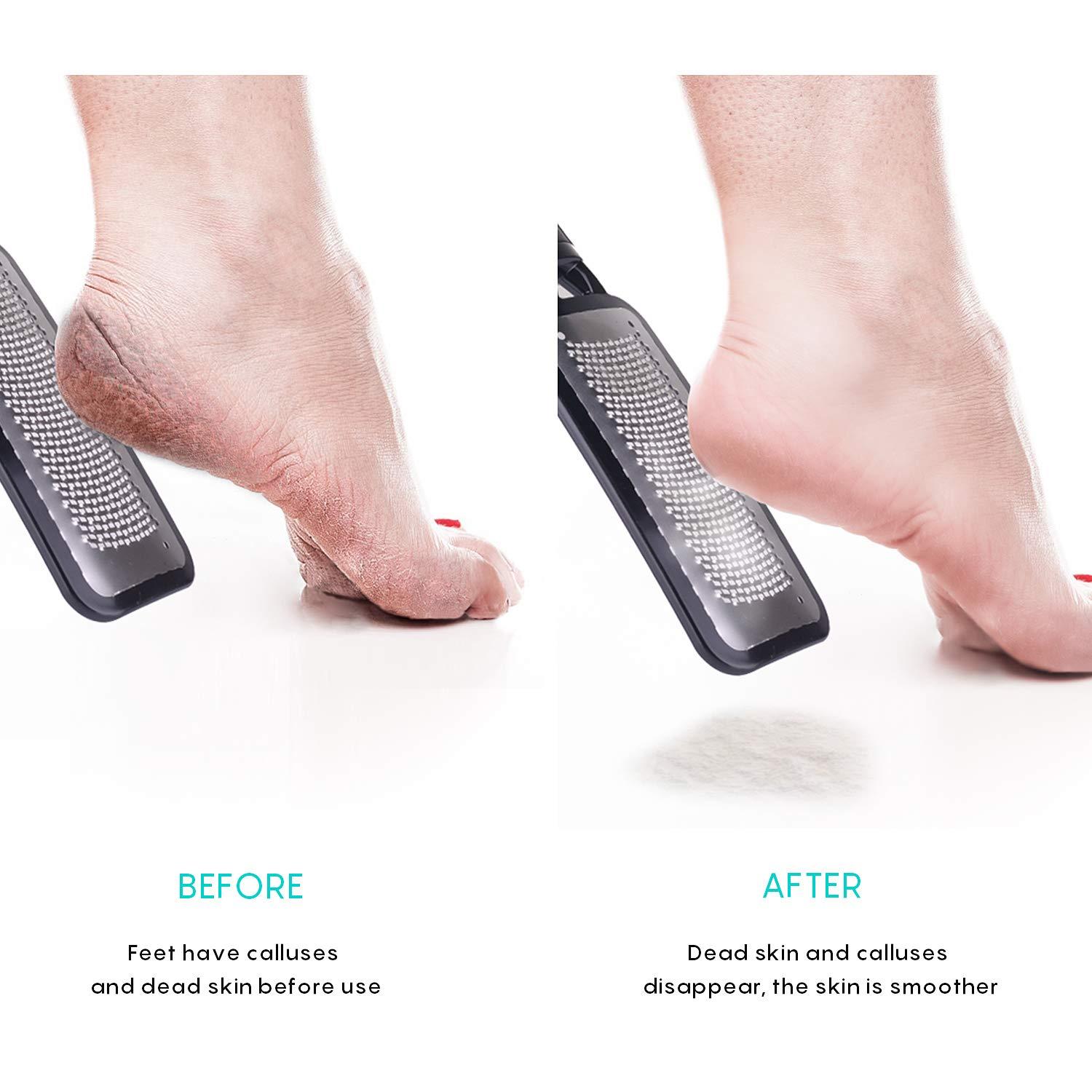 Callus Remover Foot Scrubber Colossal Foot File Foot Care And Foot  Exfoliator Foot Rasp Pedicure Tools Pumice Stone For Feet,remove Corn Hard  Skin Dea