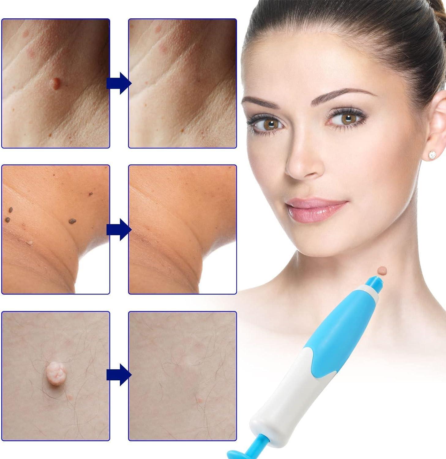 Skin Tag Remover Device 40x Removal Bands for Fast & Effective Wart