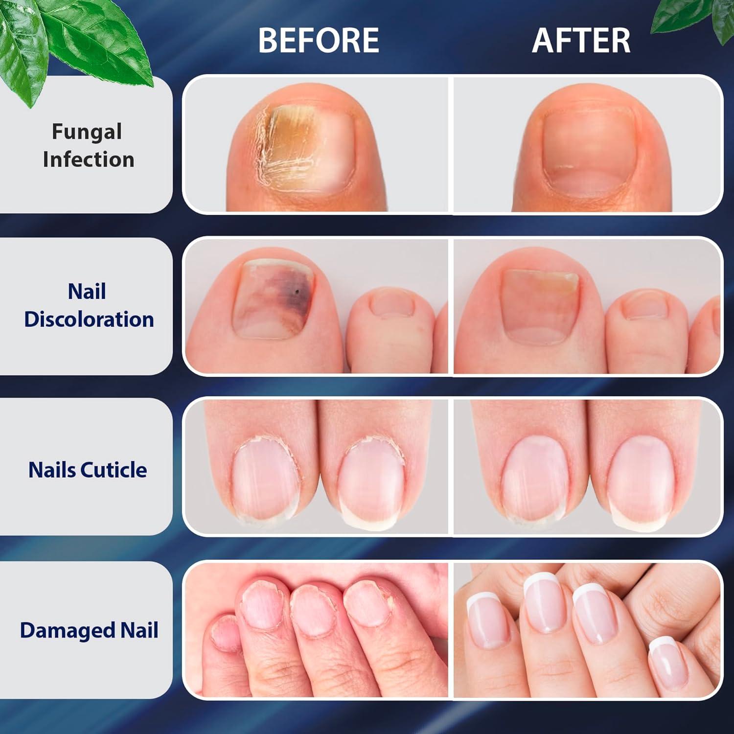 Fungal best sale toenail treatment