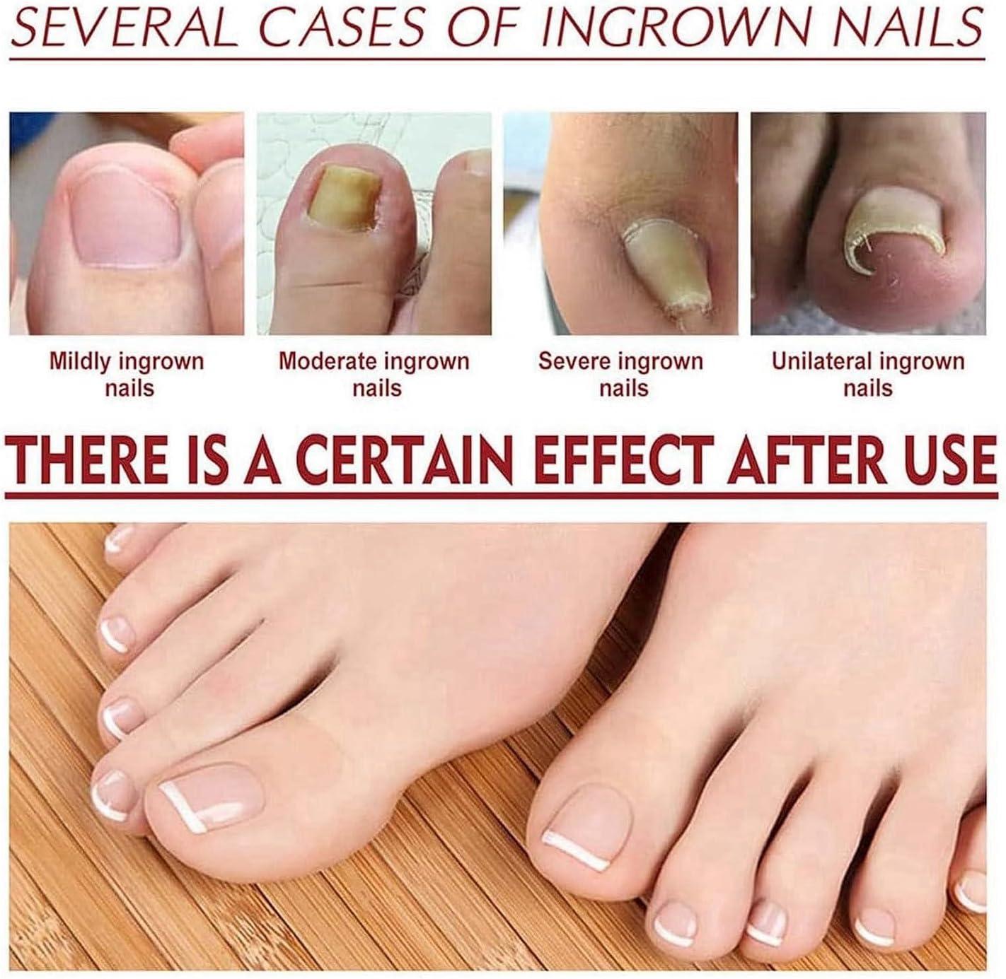 Home Care for an Ingrown Toenail: South Sound Foot & Ankle: Podiatric  Medicine and Surgery