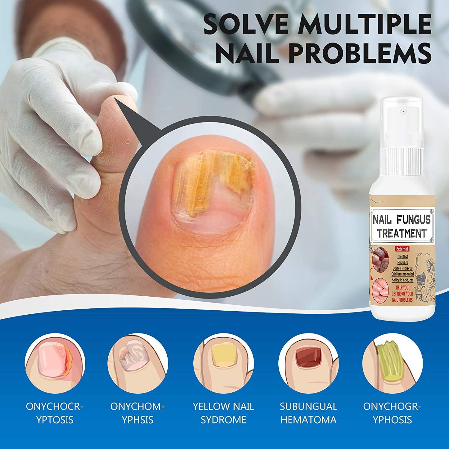 Nail Fungus Treatment for Toenail, Effective Toenail Fungus Treatment