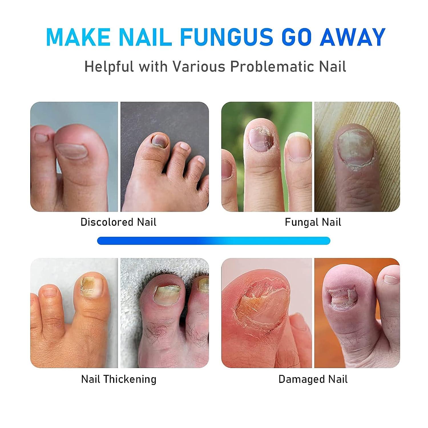 Nail Fungus Laser Treatment Device for Toenails and Fingernails Home