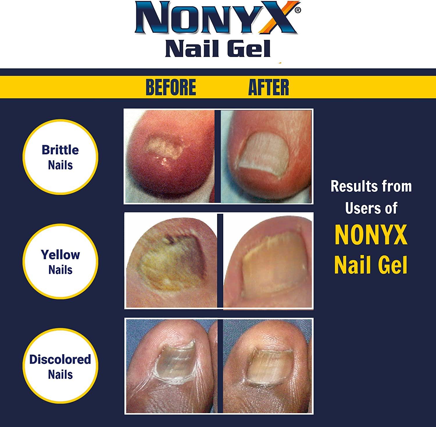 Does Nonyx Nail Gel Kill Fungus