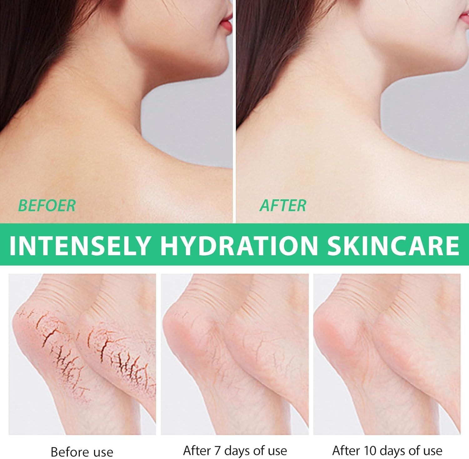 Urea 40% Foot Cream+2% Salicylic Acid Moist Cracked Heel Repair Cream ...