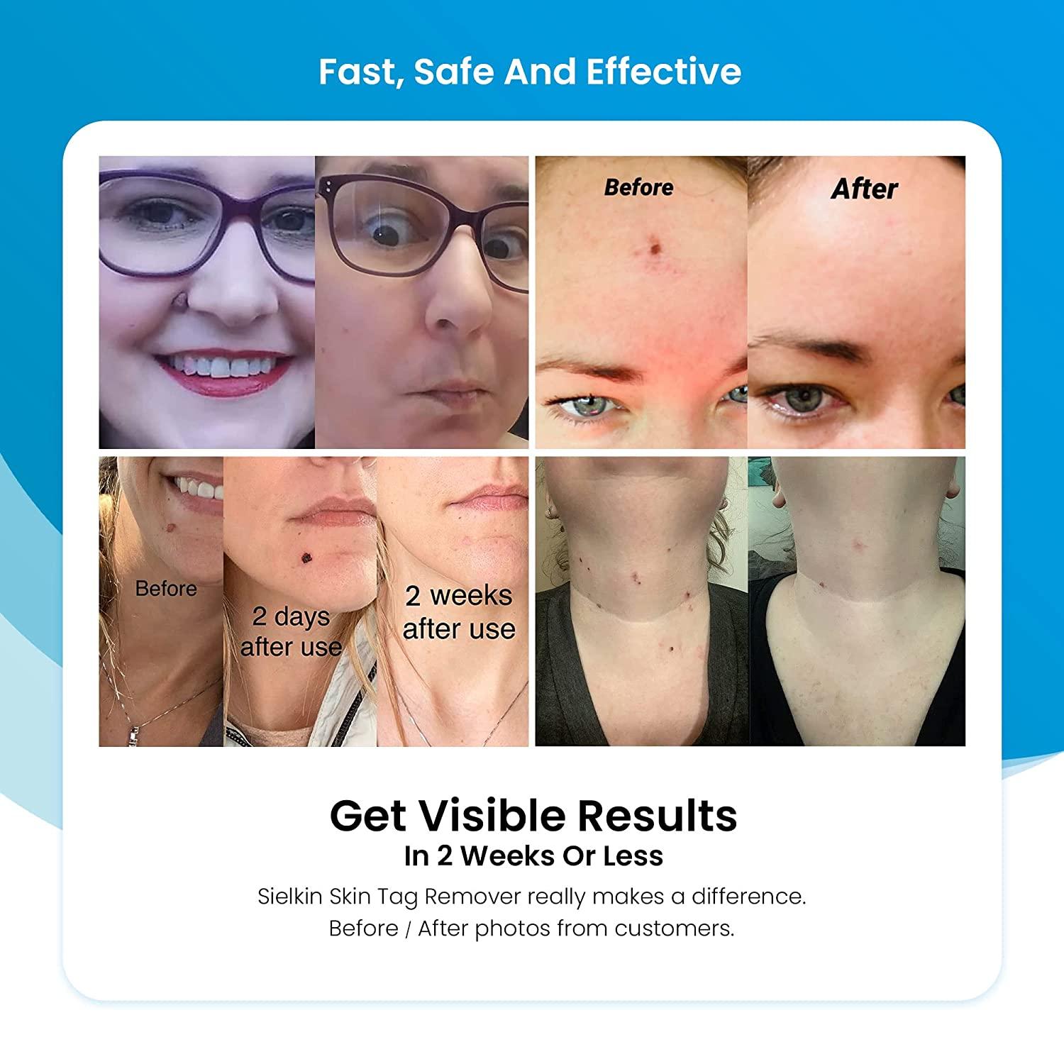 Upgrade Skin Tag Remover Kit for Men & Women 36 Skin Shields & Repair Lotion Safe and
