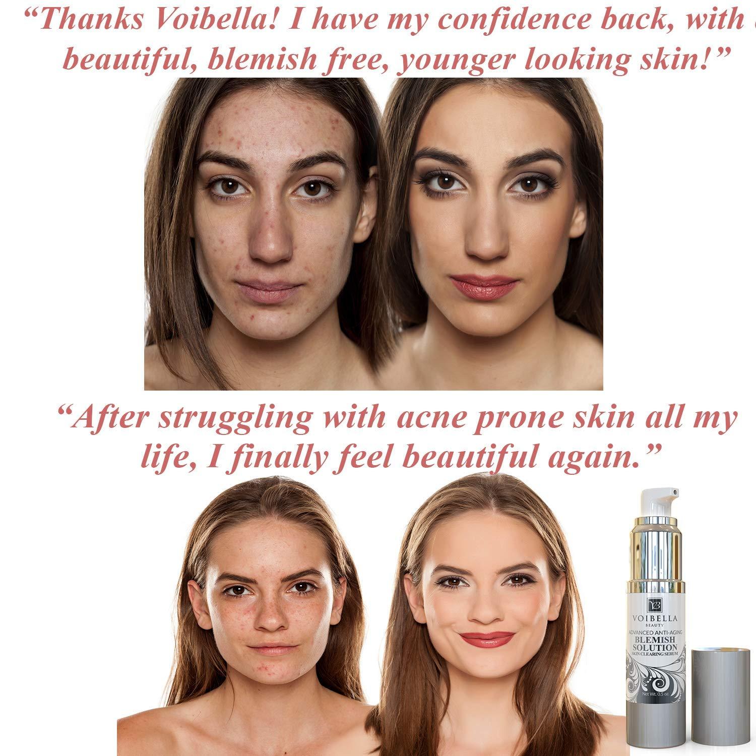 Best Blemish Remover & Anti Acne Spot Treatment Cream Natural Dark