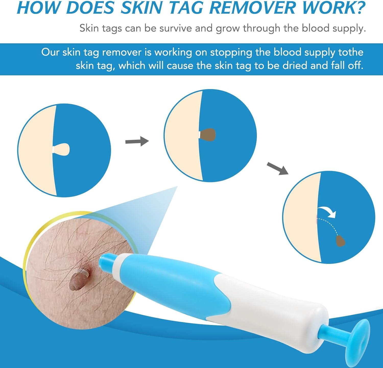 Is Vora Skin Tag Remover Legit Skin Tag Remover Kit with Auto Pen, 40 Bands - Painless Device for