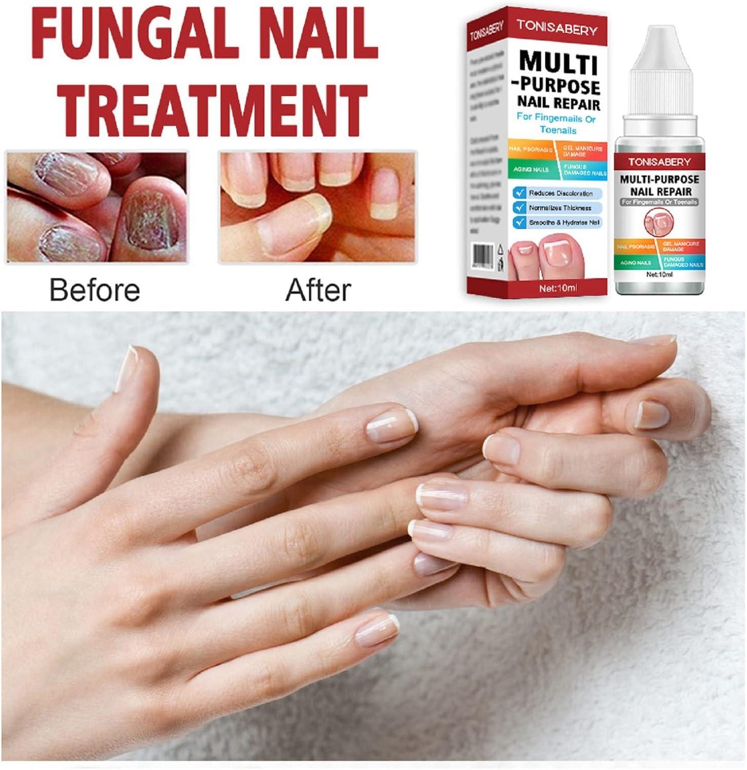 Travelwant 30ML Extra Strength Toenail Fungus Treatment Nail Fungus  Solution for Toe Nail & Fingernails - Fix Thick, broken & Fungal Discolored  Nails- Renew Fungi Damaged Nail - Walmart.com