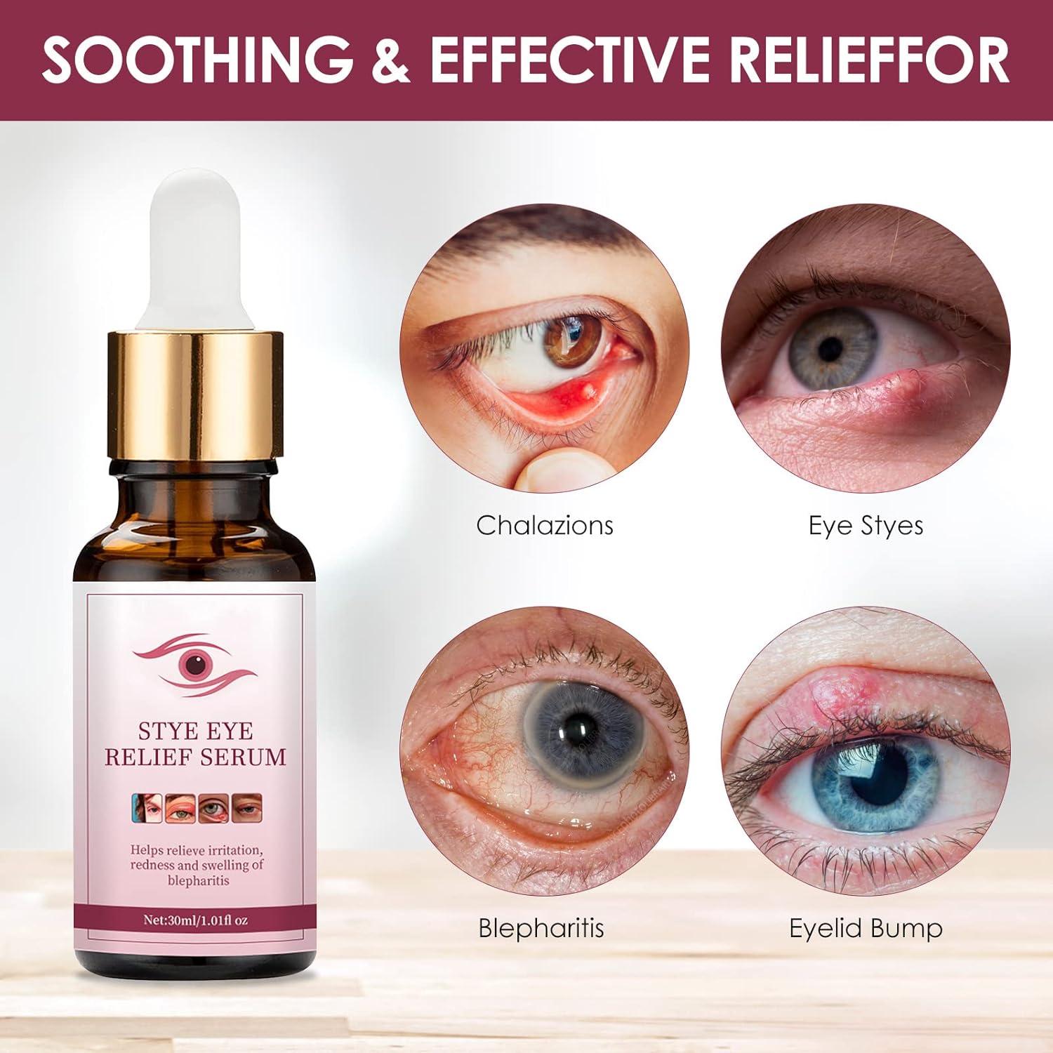 Stye Eye Treatment Chalazion Remover Fast Relief Serum for Eye
