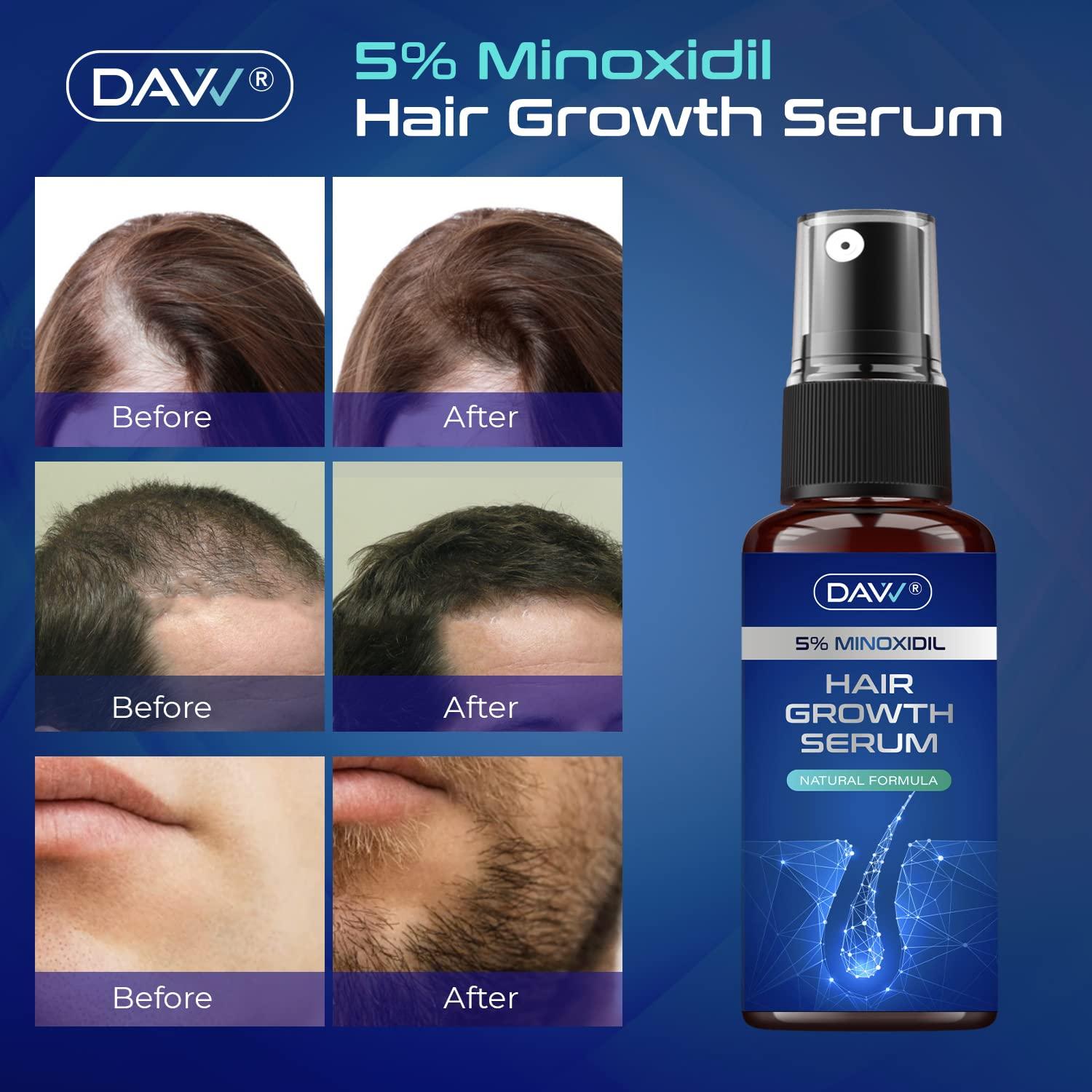 5% Minoxidil Hair Growth Serum For Men And With Biotin Hair Regrowth  Treatment For Stronger Thicker Longer Hair help to Stop Thinning and loss  hair 60Ml 1 Month supply