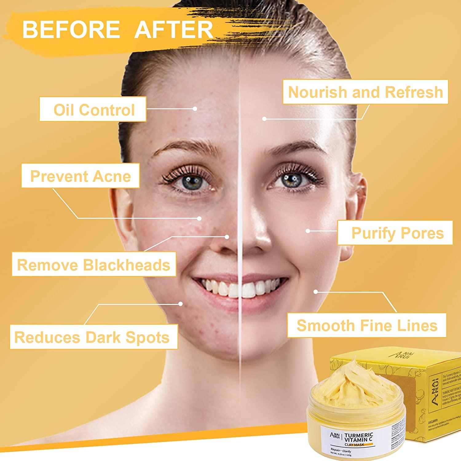ANAIRUI Turmeric Vitamin C Clay Mask for Dark Spots, Vitamin C Clay