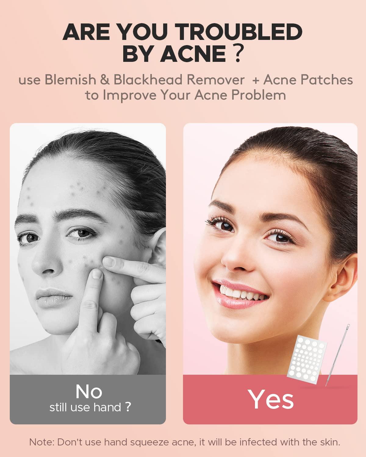 Acne Pimple Patches + Pimple Extractor, 4 Sizes 176 Patches for Zit
