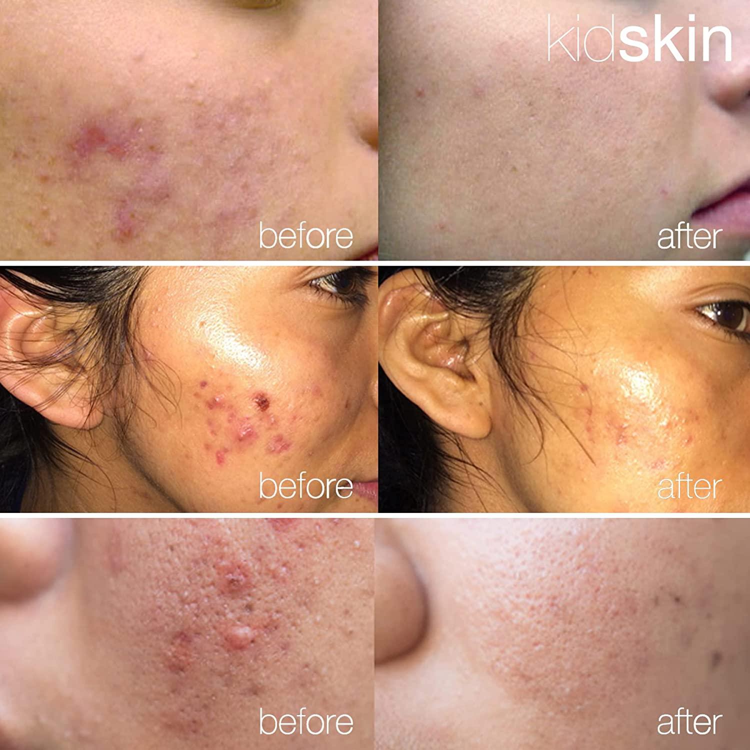 ACNE LOTION H 3点セット Kidskin Three-Step Acne Treatment Kit for Kids, Tweens