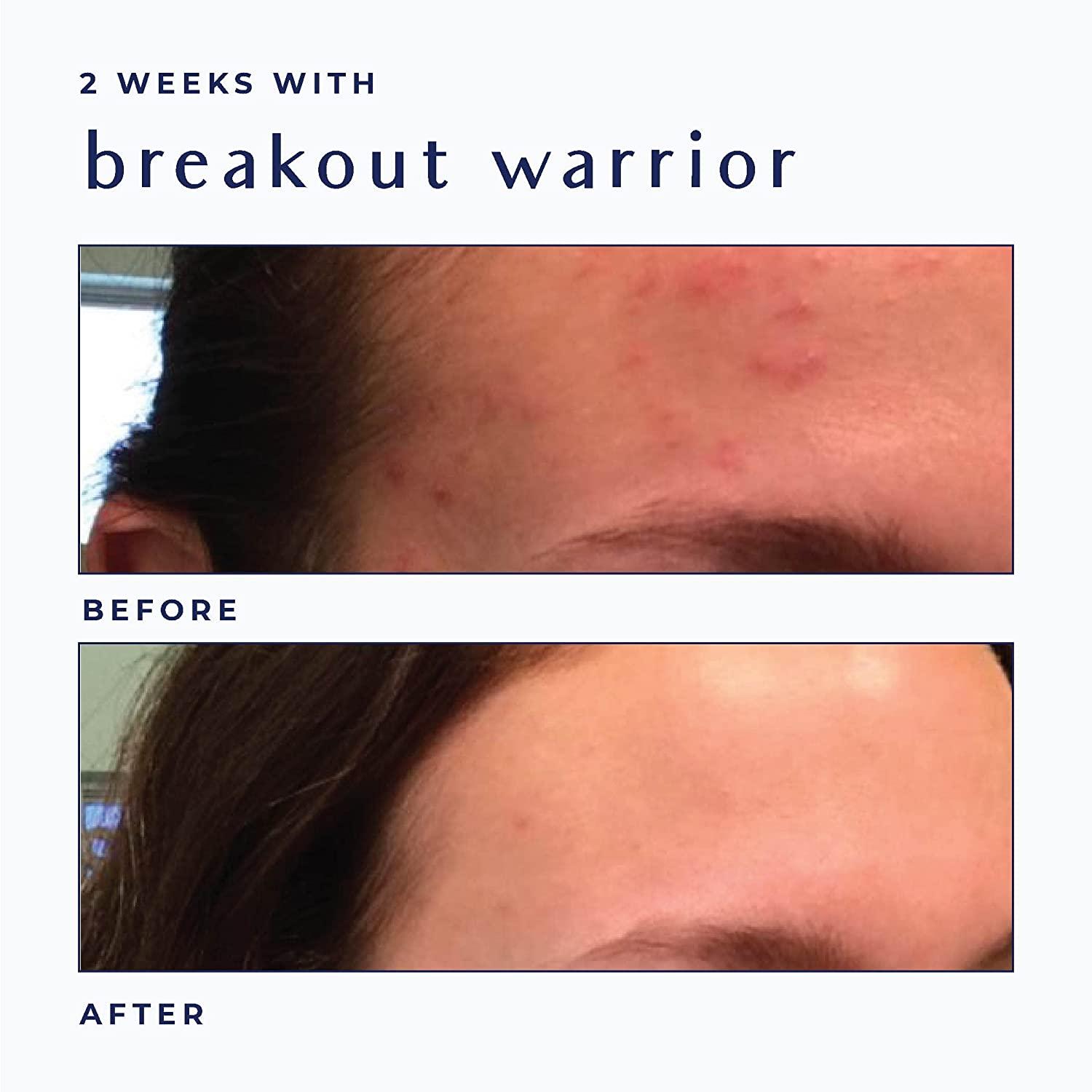 Moisturizing Acne Treatment Cream, Salicylic Acid Face Moisturizer for