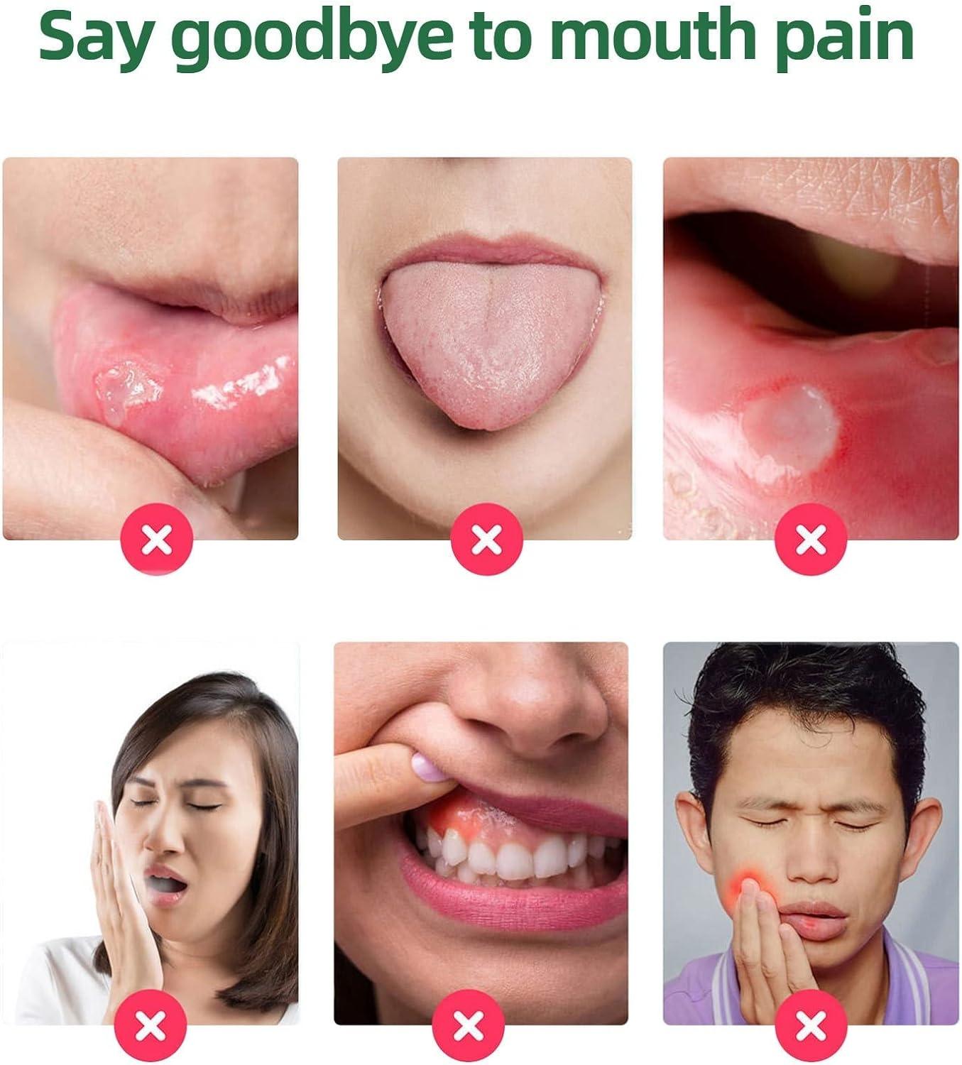 Ulcer Breath Sprays Canker Relief Spray Antiviral Mouth Spray Treat